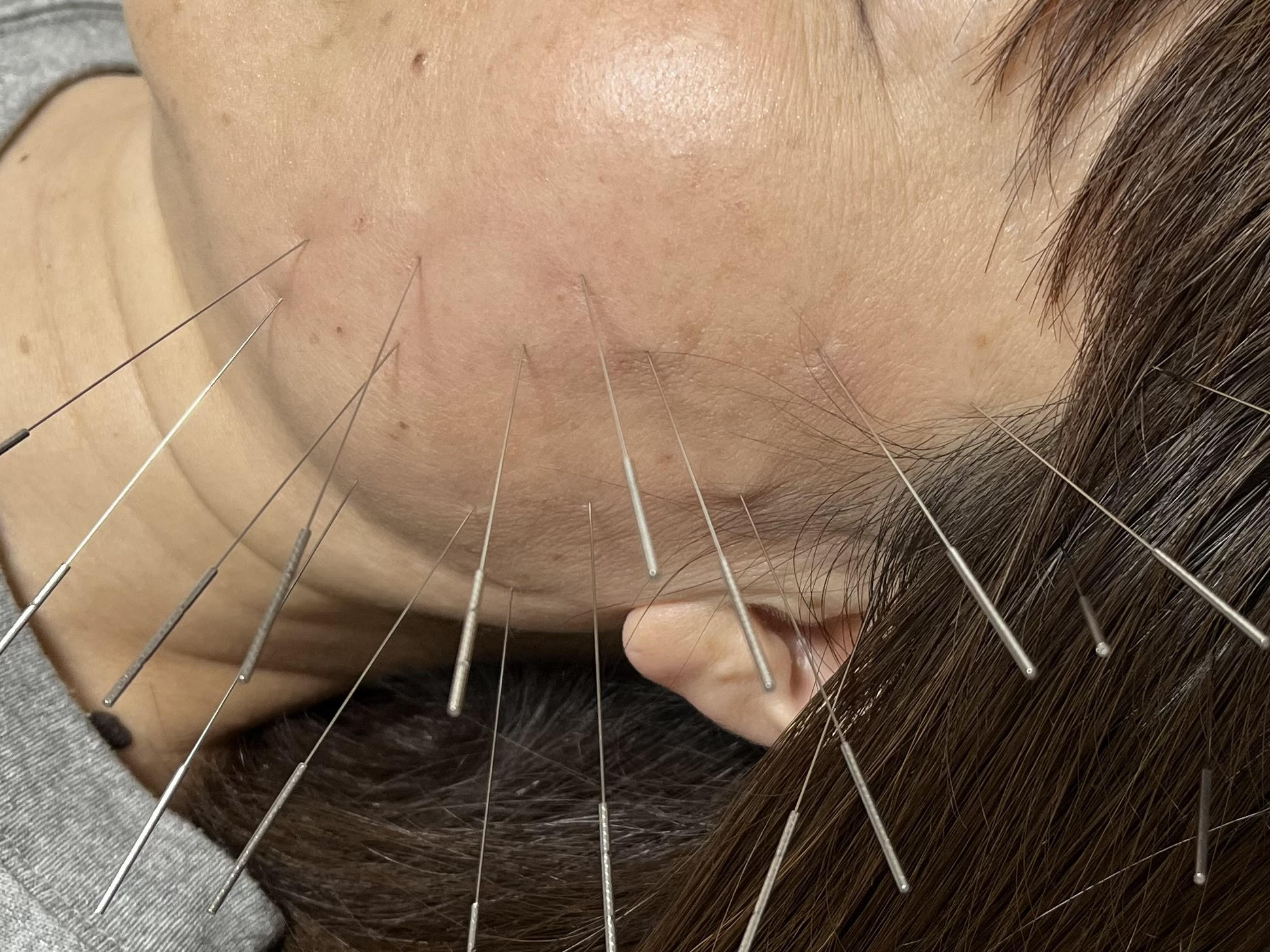 Ponoはりきゅう ルート鬼美容鍼 30分のメニュー画像