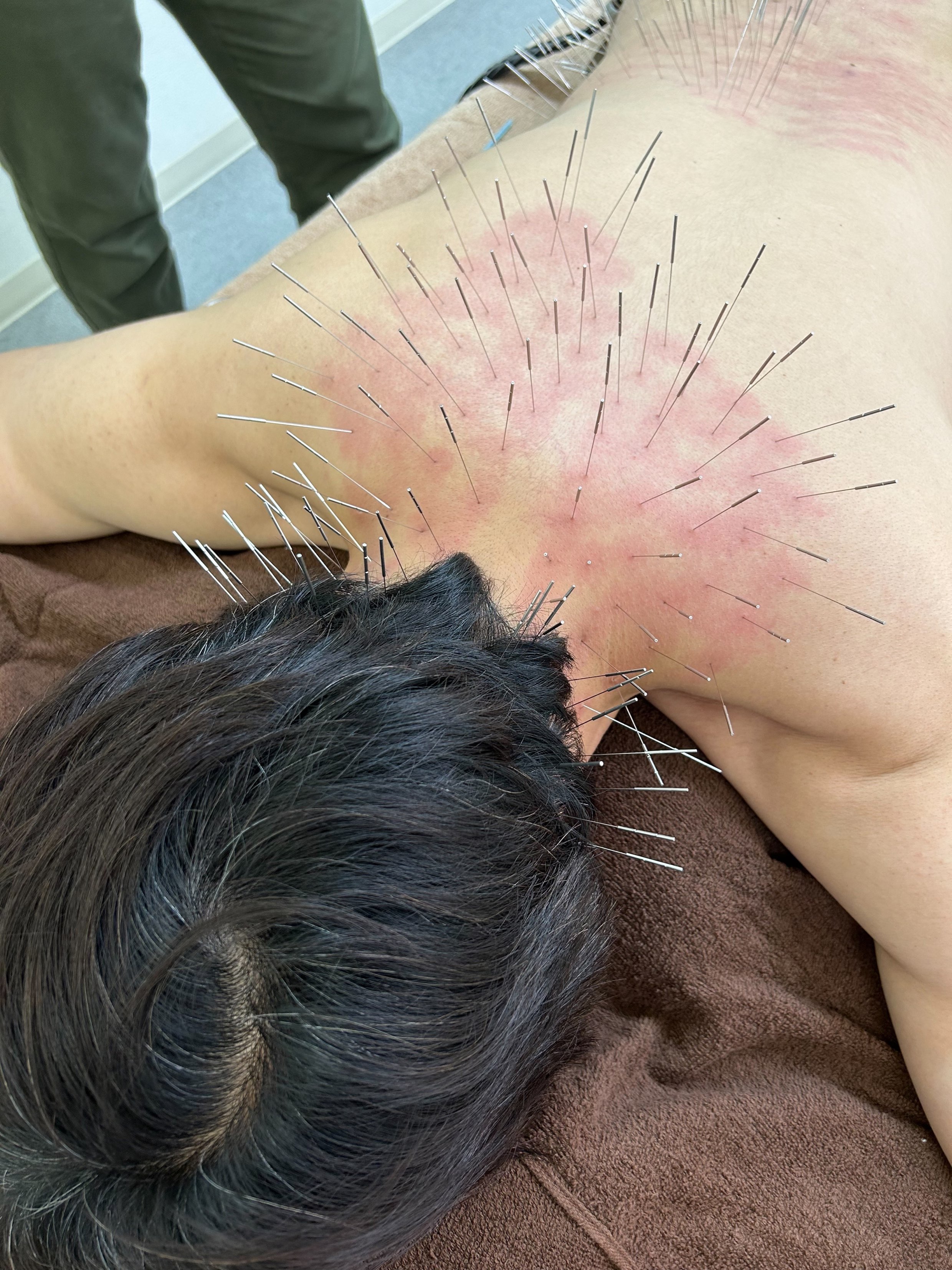 赤石はり・きゅう治療院 延長のメニュー画像