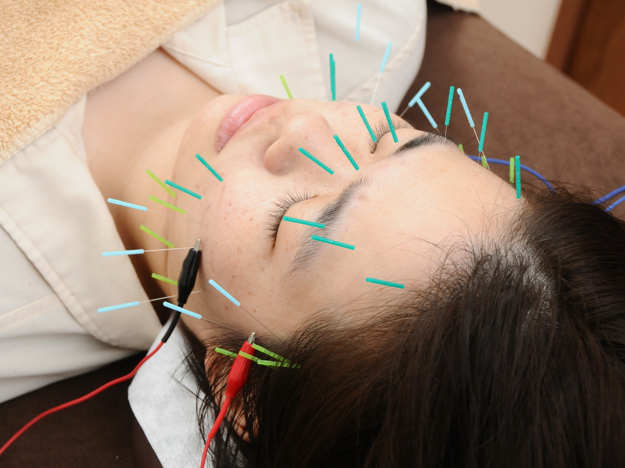 小林整骨院　立花 【女性人気No.1】美容鍼プレミアムのメニュー画像