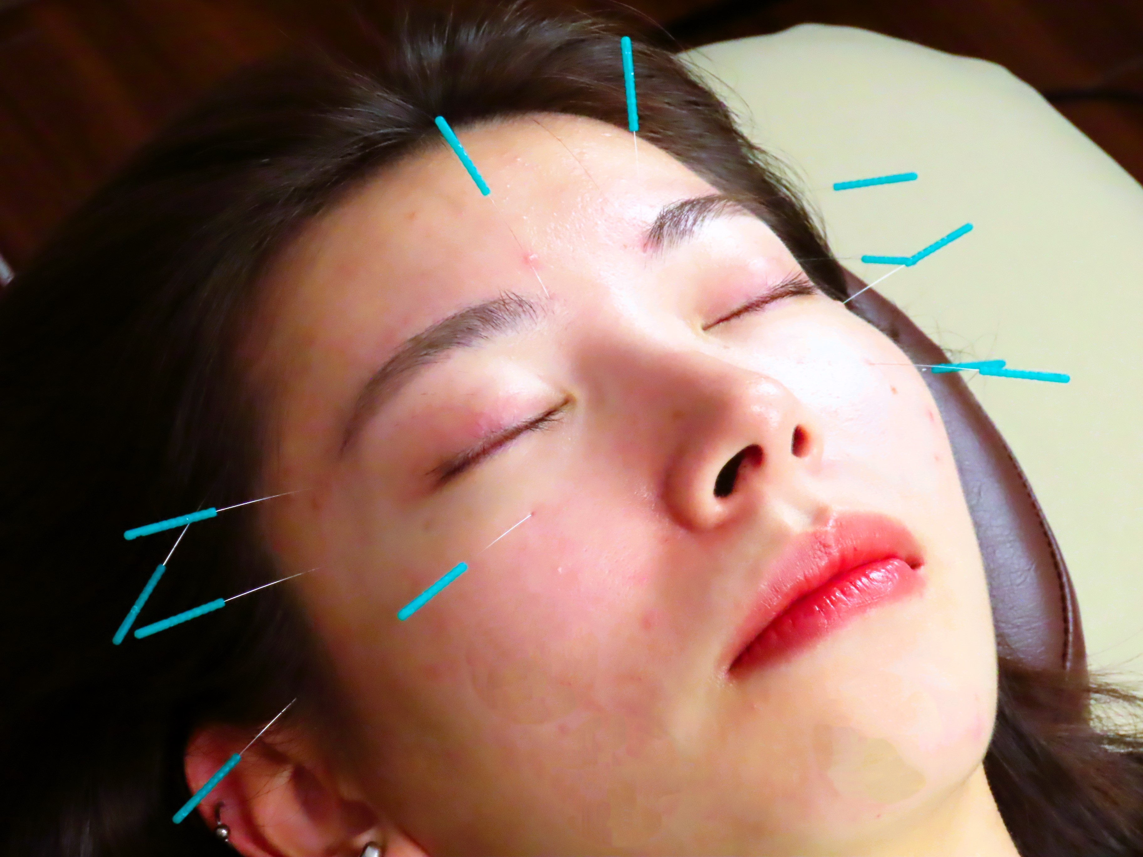 そらうみ鍼灸治療サロン 【初回の方】初回カウンセリング＋お試し美容鍼コースのメニュー画像