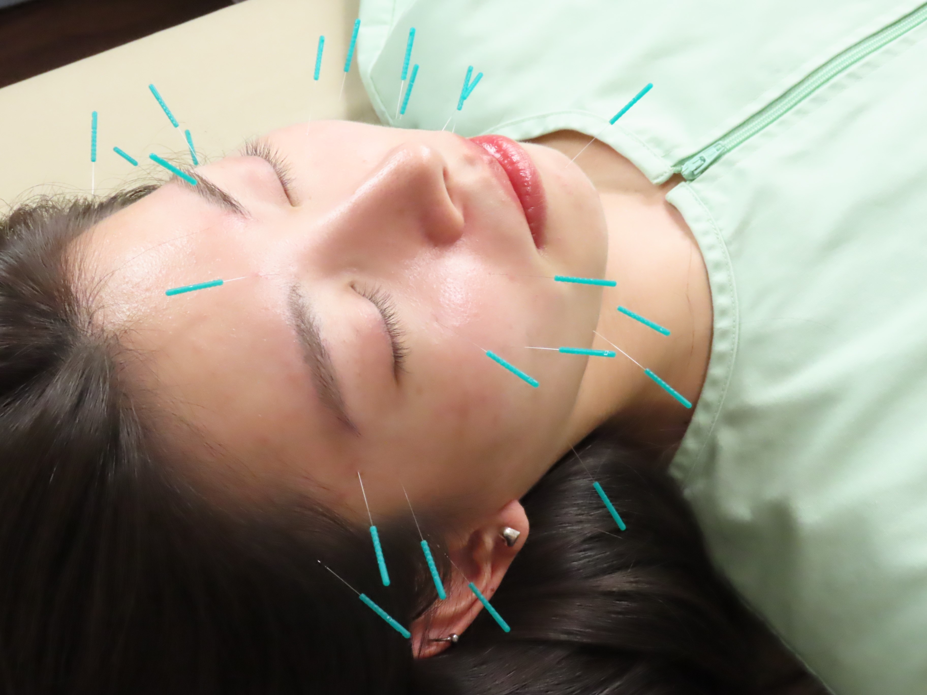 そらうみ鍼灸治療サロン 【初回の方】初回カウンセリング＋美容鍼コースのメニュー画像