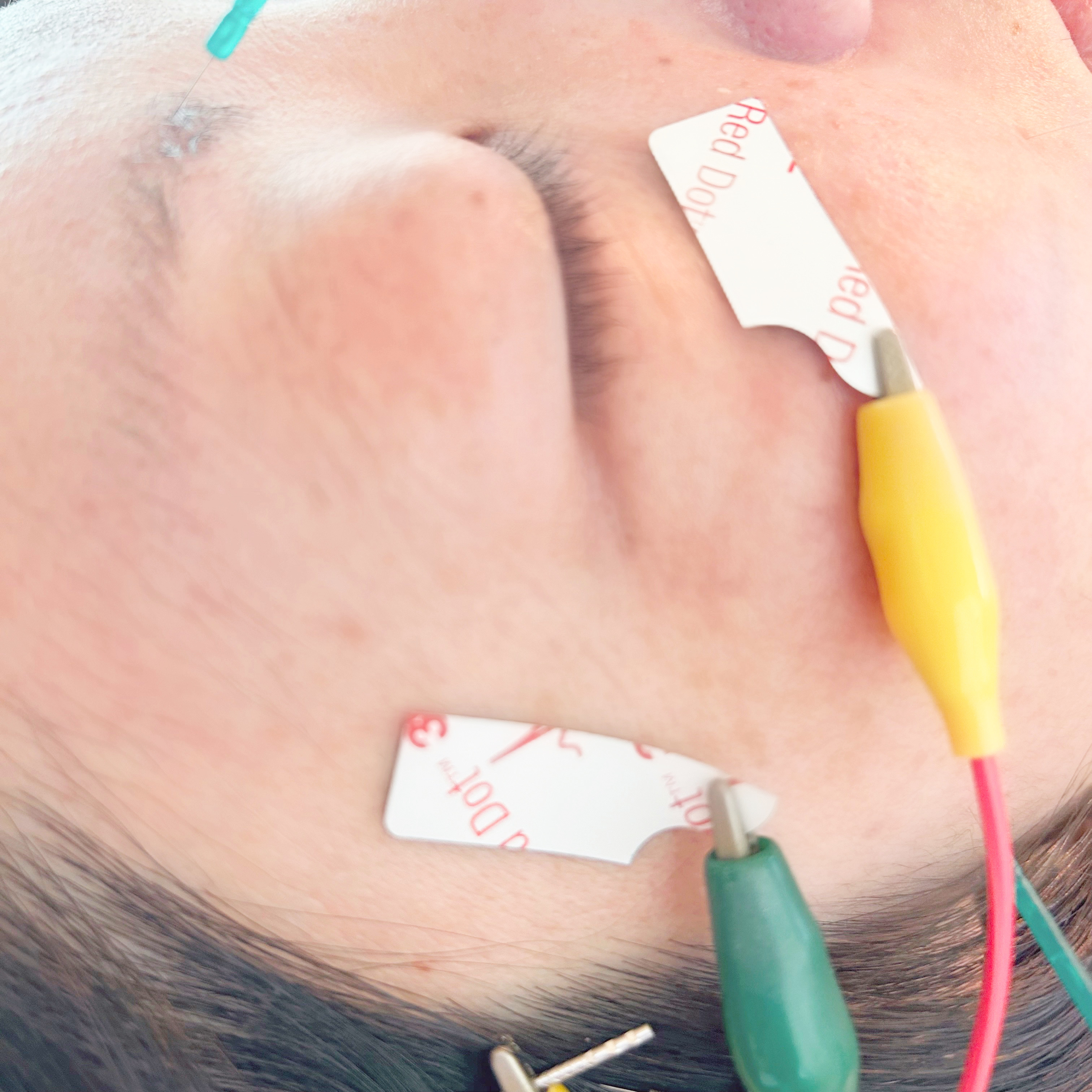 こもれび鍼灸院 美容鍼　目元スペシャルのメニュー画像