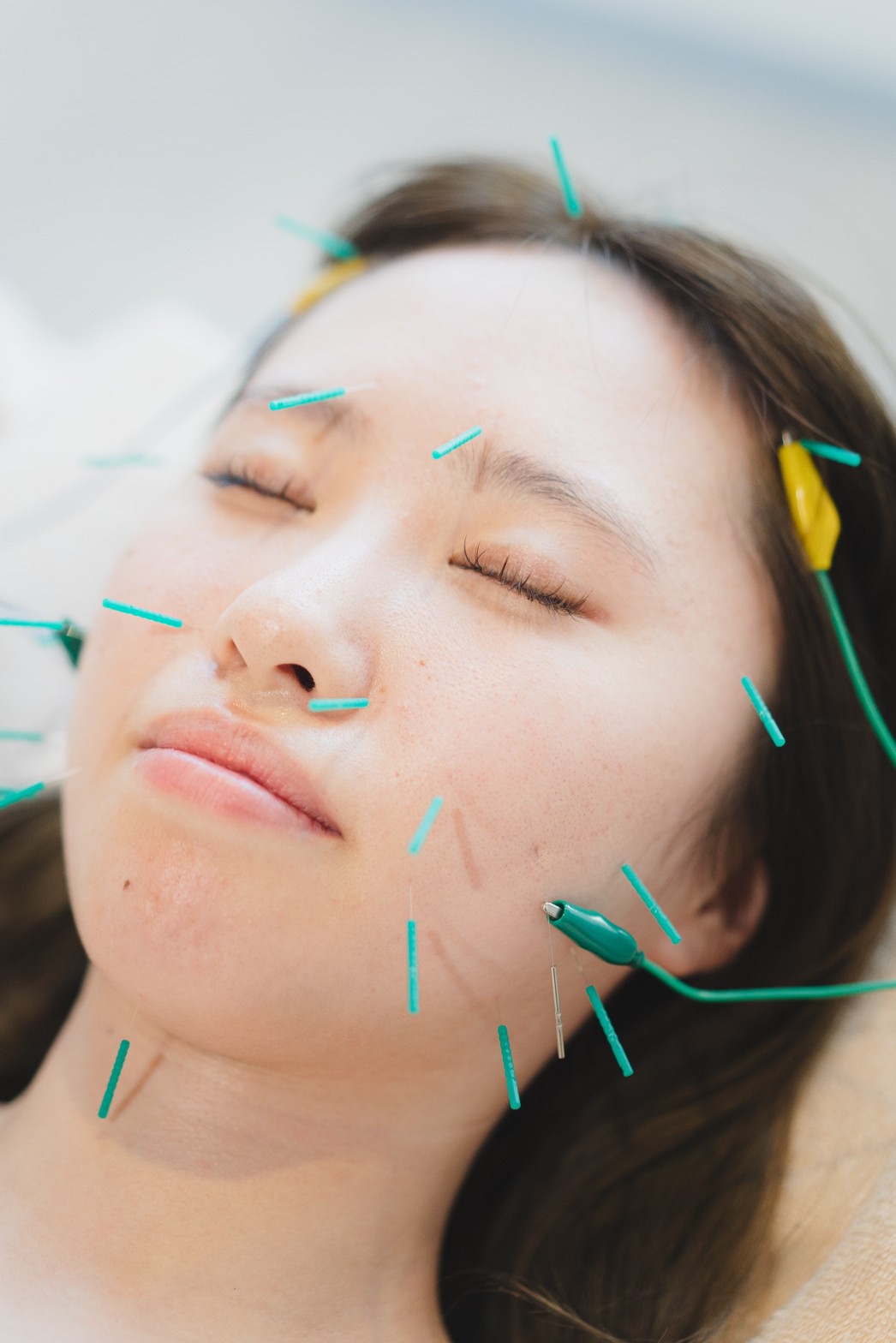 acuness 美容鍼プラチナコース11000円のメニュー画像