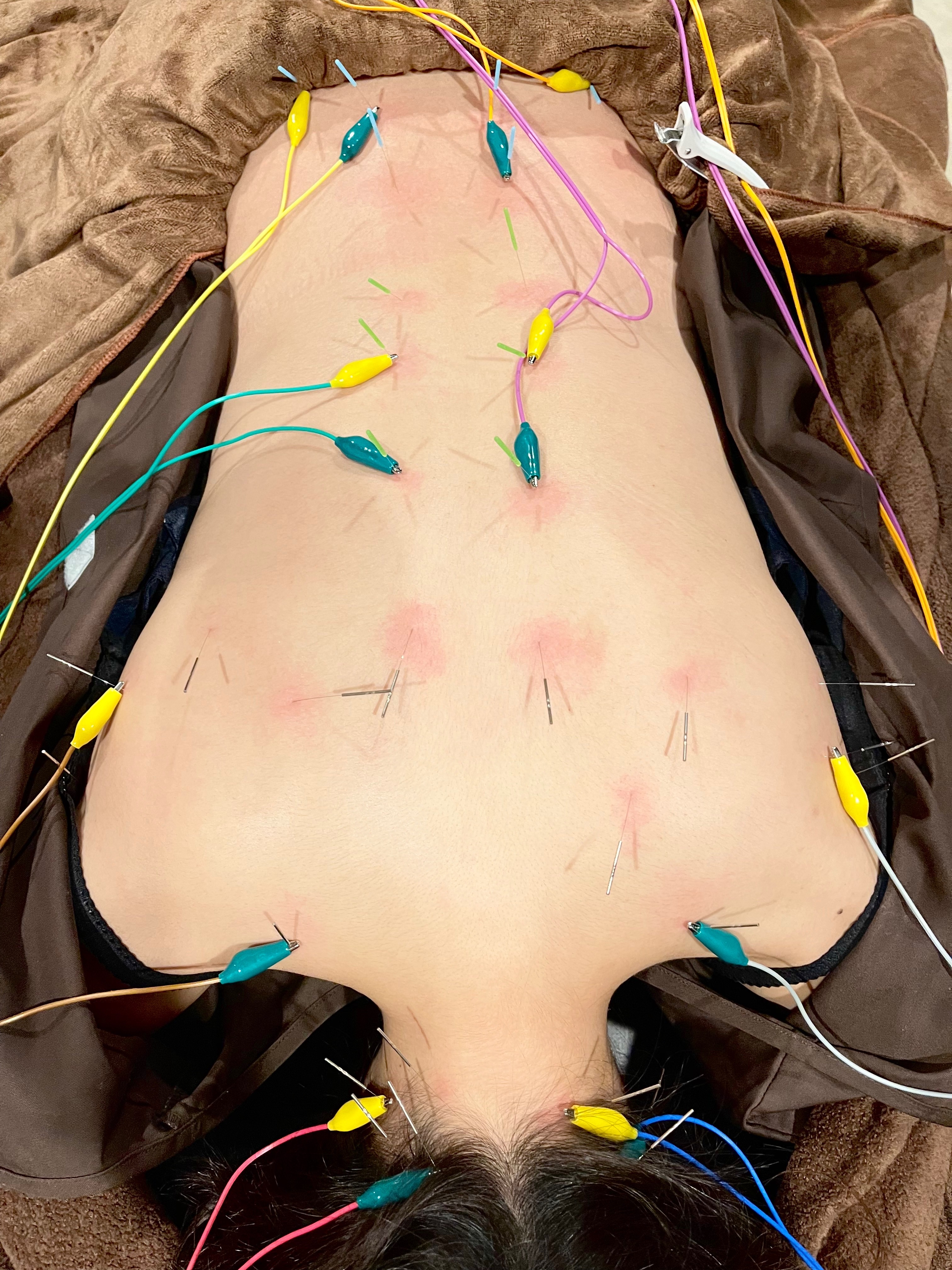 美容鍼灸院　HARI美癒 背部治療30分のメニュー画像