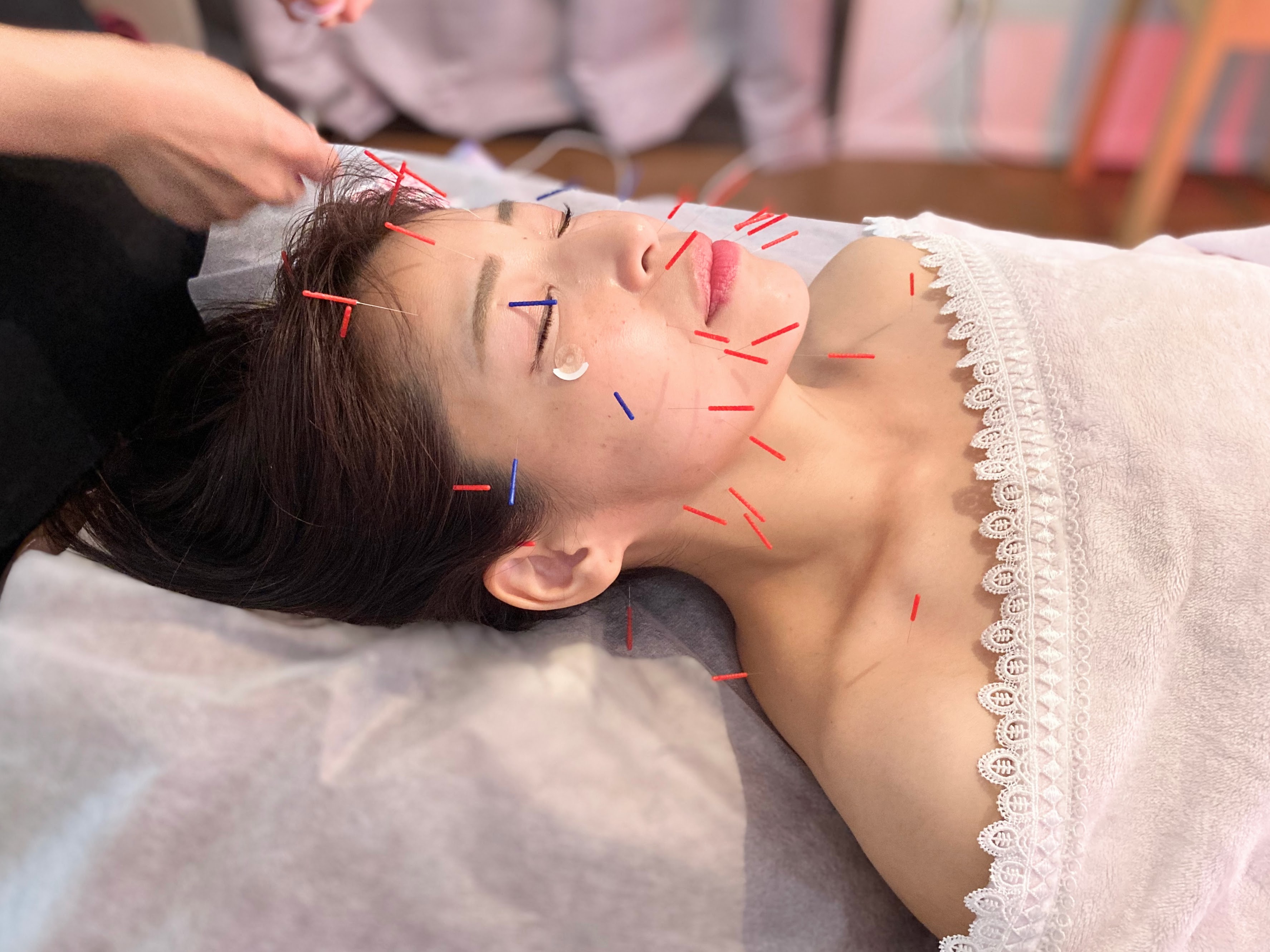 美容鍼灸サロン 漢方美人 お顔、首、デコルテ美容鍼【美容鍼+電気】フェイシャル 首肩デコルテのオイルトリートメント かっさ 頭皮のマッサージ付きのメニュー画像