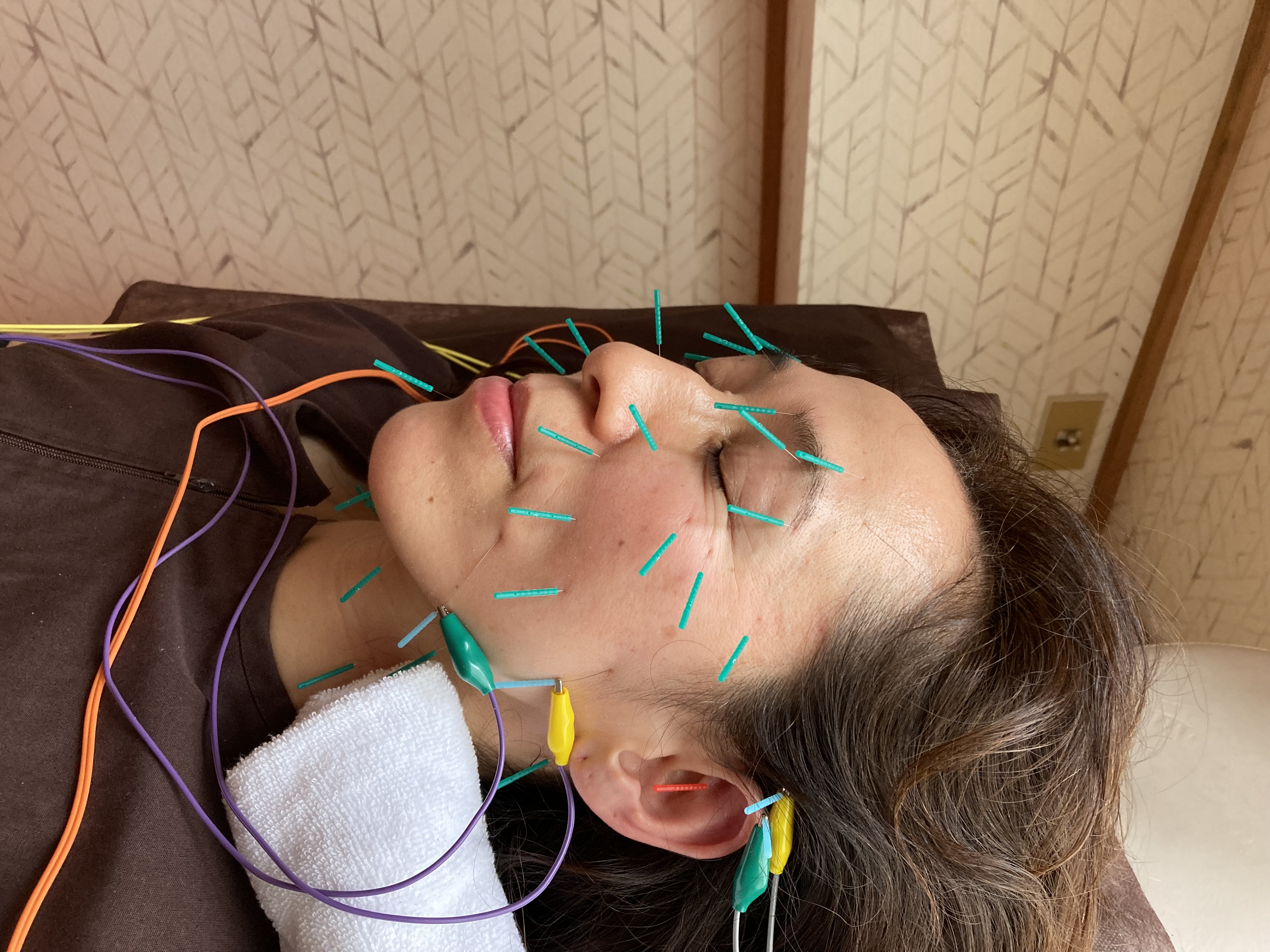 今田屋内科併設　表町鍼灸院 美容鍼プレミアムトライアルのメニュー画像