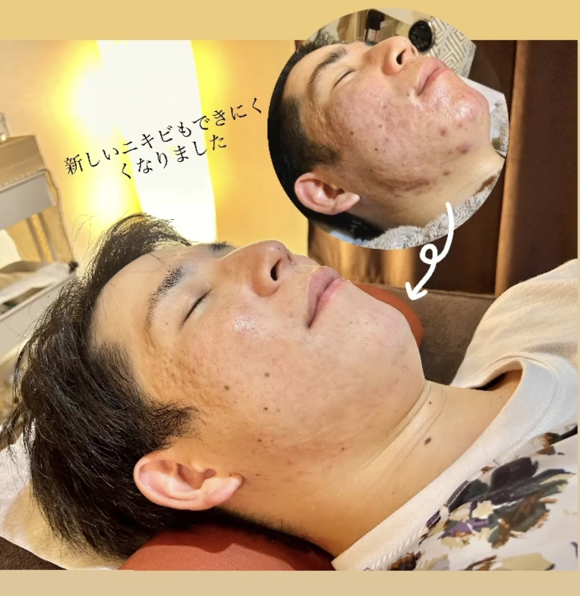 月陽堂鍼灸治療院 ニキビ治療（お顔＋身体）のメニュー画像