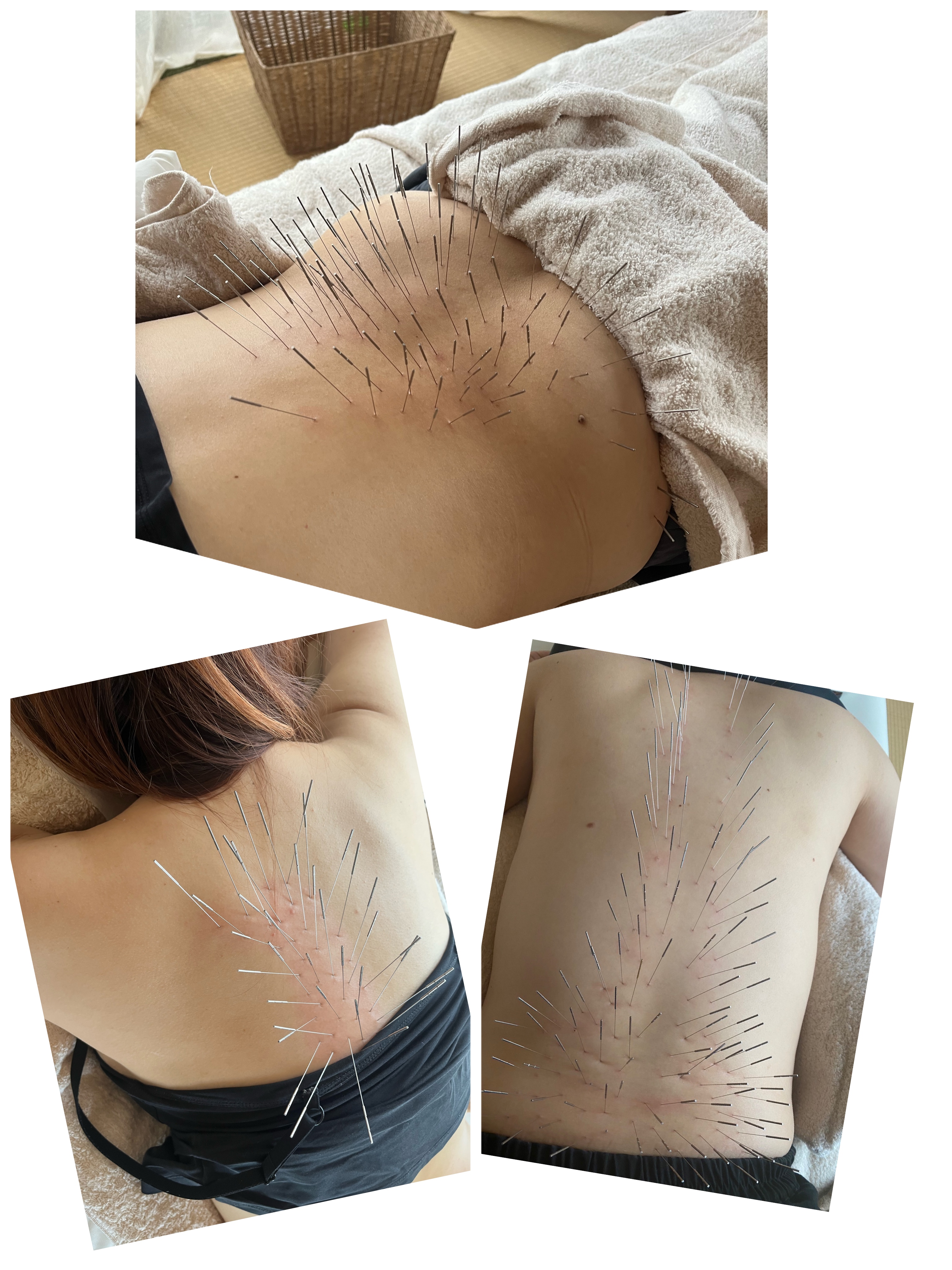 鍼灸salon　 ASENS   ルート治療院 【高砂院】ルート鍼治療45分のメニュー画像