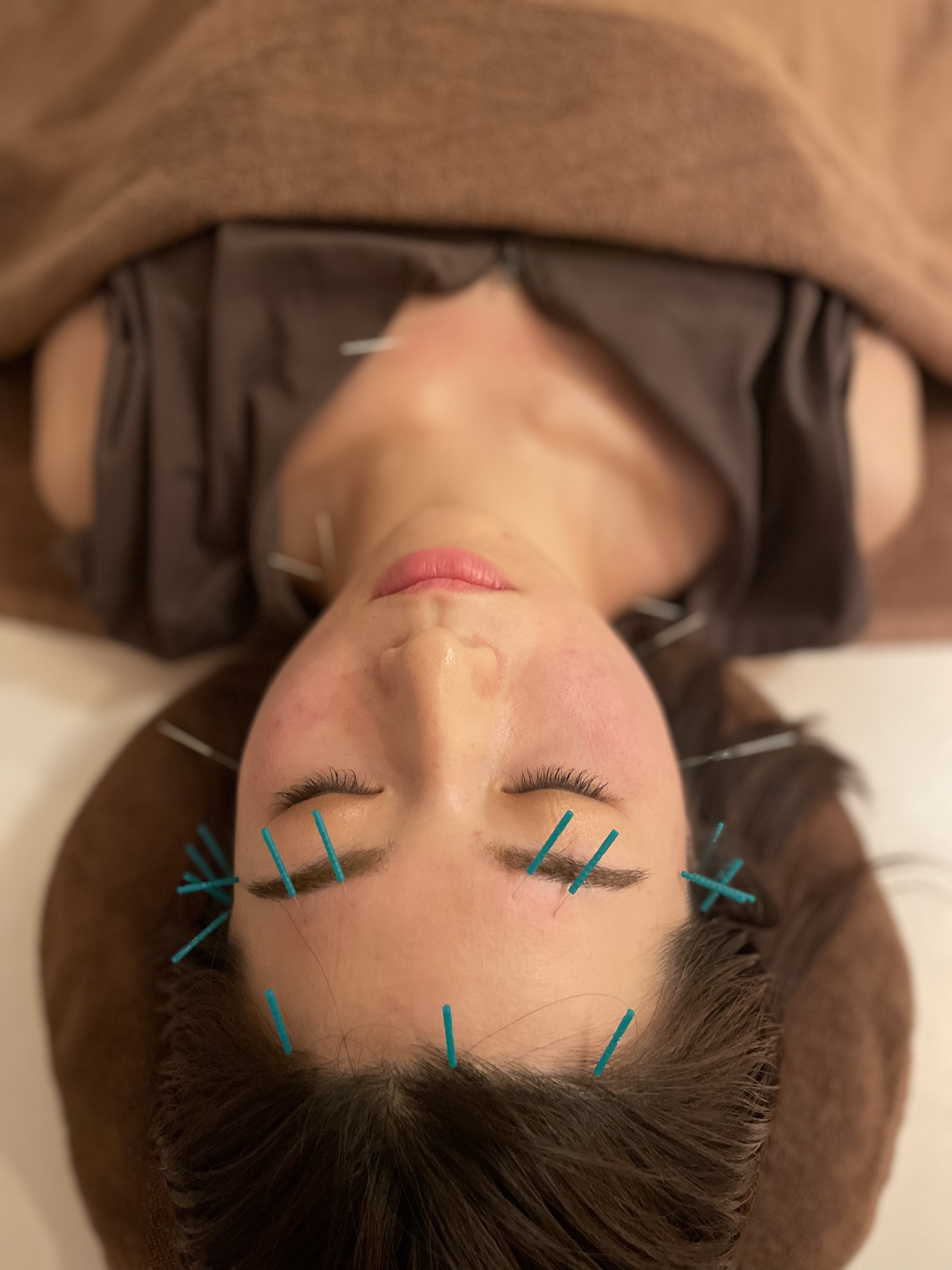 ひまわり鍼灸メディカルサロン横浜 「集中美容鍼」効果を早く感じたい方！のメニュー画像