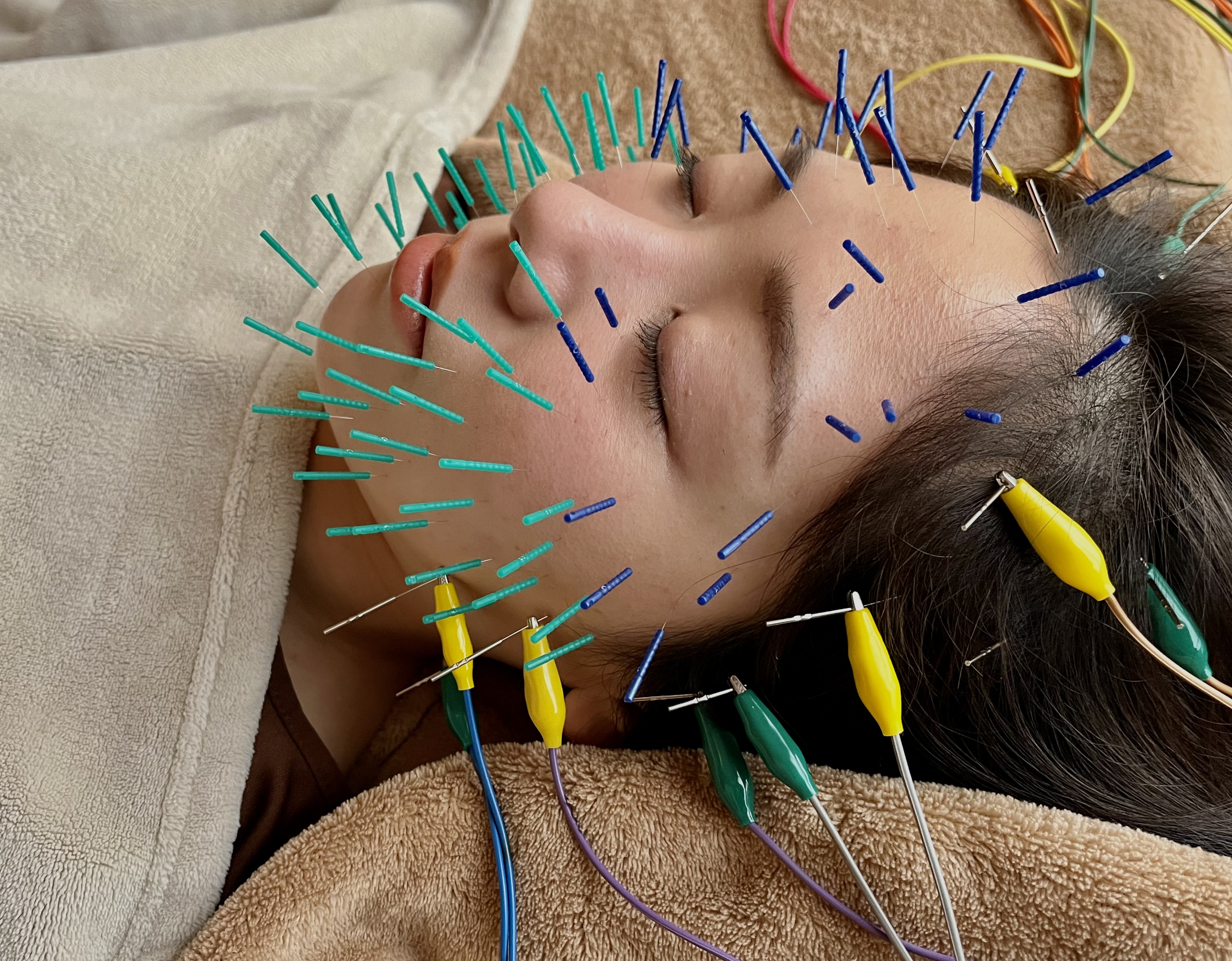 HARiET ヘッジホッグスキン美容鍼70分のメニュー画像