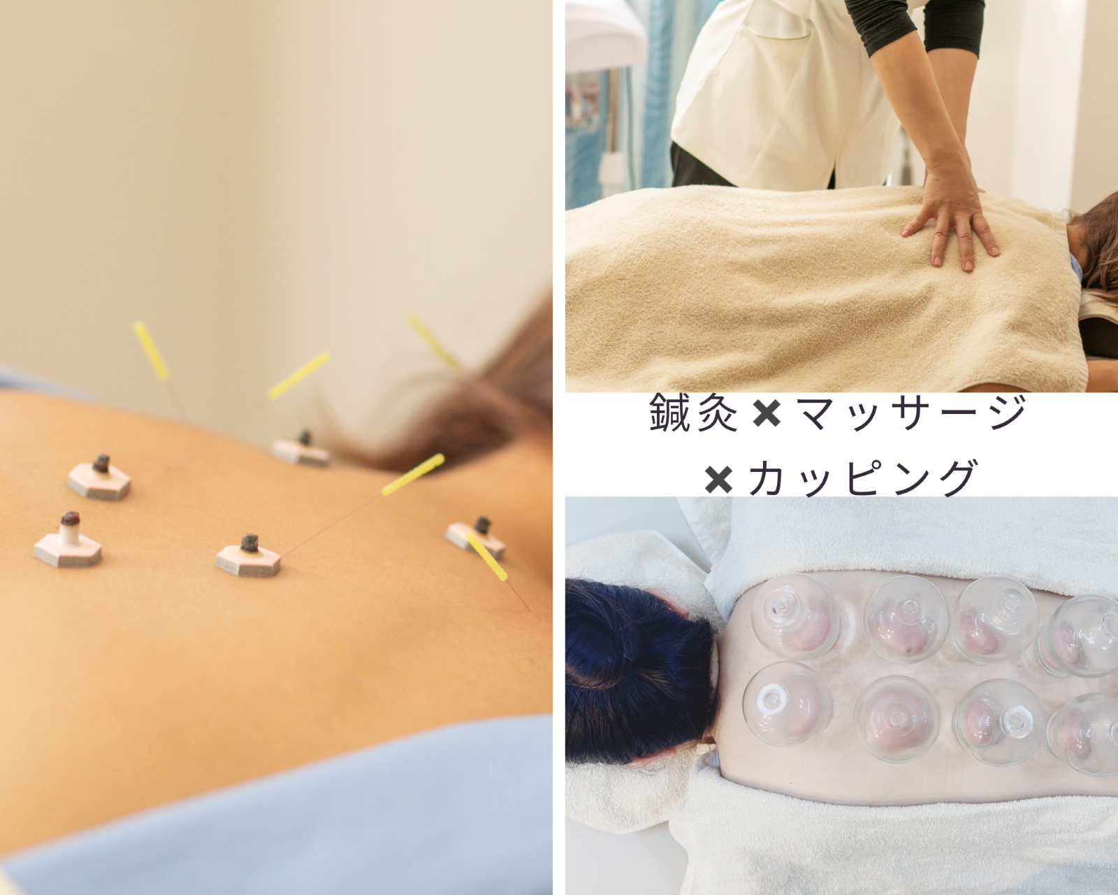 UTUKUSHI 【首肩・腰・慢性疲労】鍼灸マッサージ＋カッピングのメニュー画像