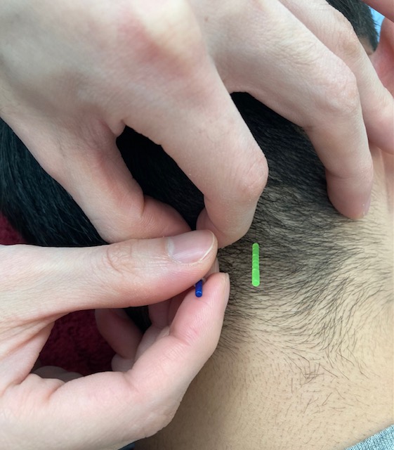 東洋堂治療院　漢方・自然薬 東洋堂 発毛・育毛鍼治療のメニュー画像