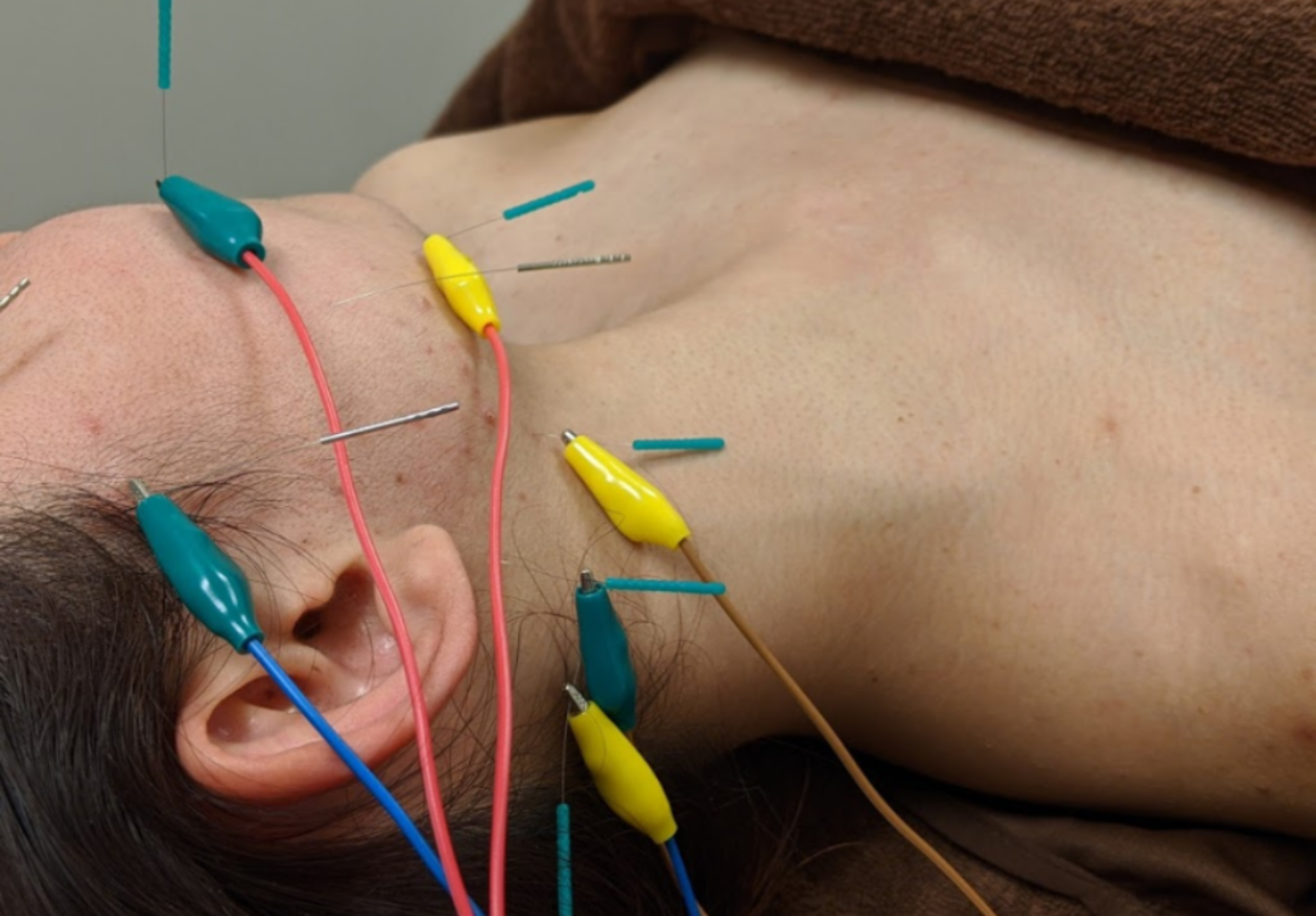 ONE LIGHT 美容鍼灸（ベーシック）のメニュー画像