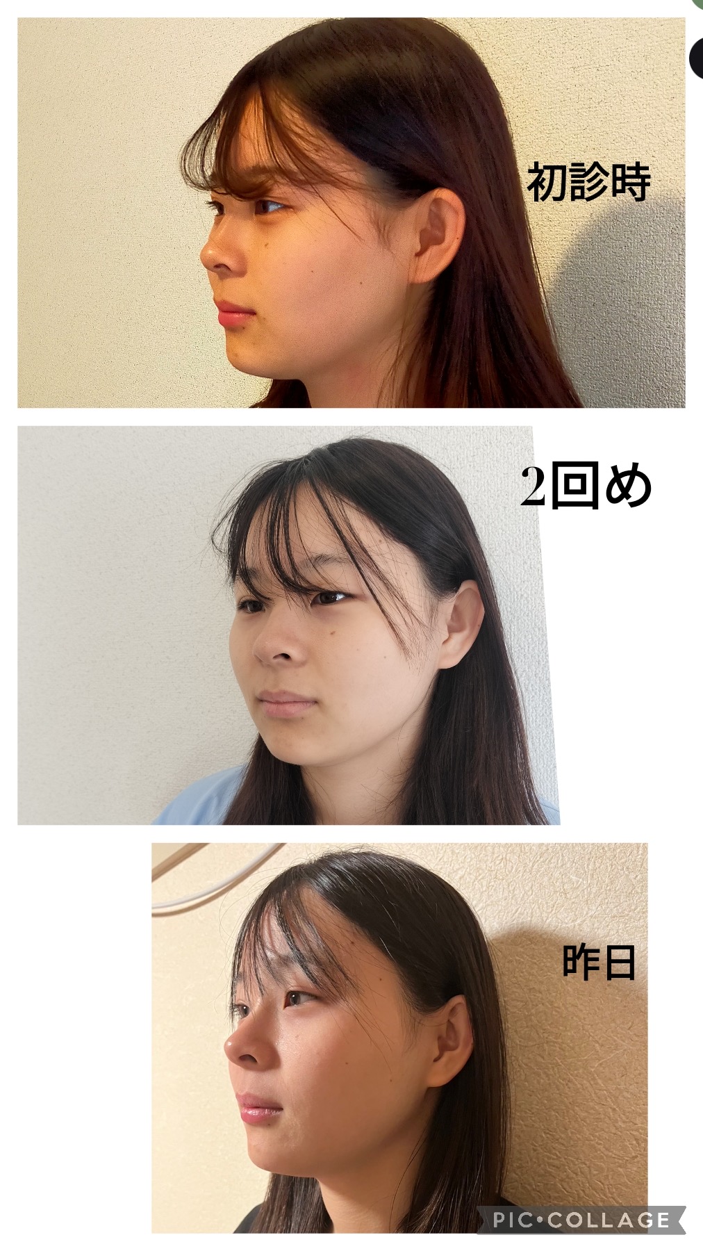 鍼処　卓－taku－  ルート治療専門院 ルート鬼美容鍼のメニュー画像