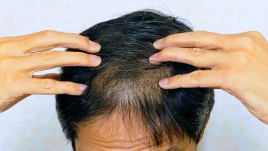 鍼灸･整体　かんなり治療院 ルート治療　薄毛改善育毛鍼コースのメニュー画像