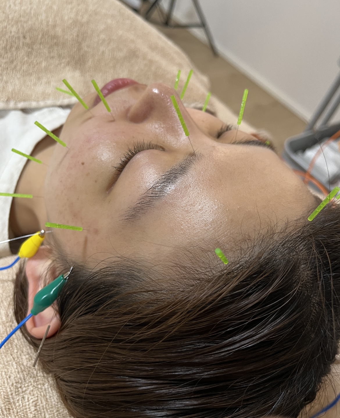鍼灸院　はりのひと 首肩がお辛い方へ⭐︎ 美容鍼✖️デコルテ首肩オイル（高濃度酸素オイル使用）のメニュー画像