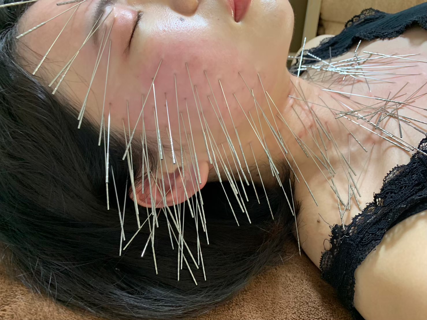 鍼灸サロン　月と恵 ルート治療30分＋鬼美容鍼30分のメニュー画像