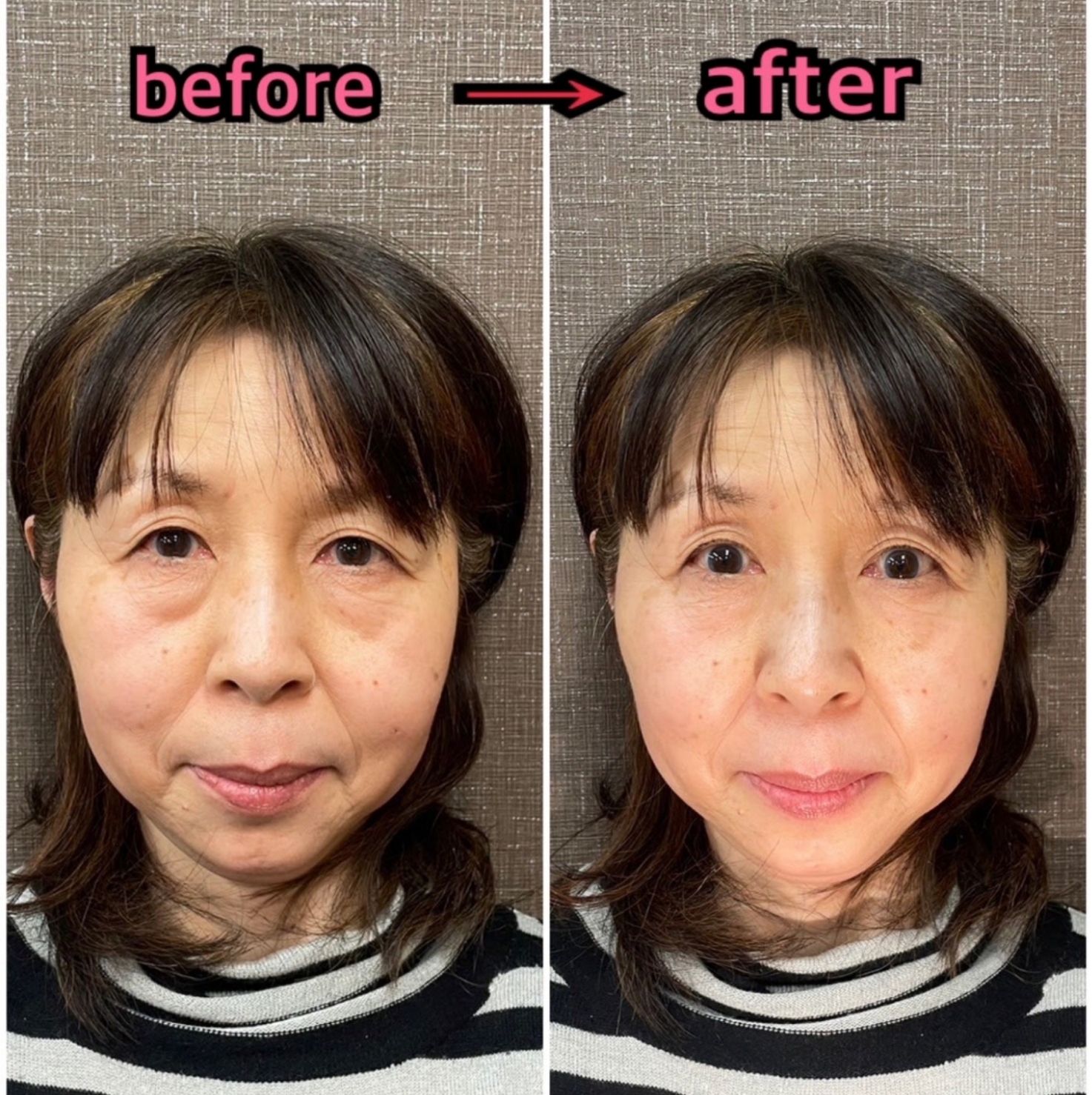 福山小顔美容鍼サロン 超小顔美容鍼コース(初回）のメニュー画像