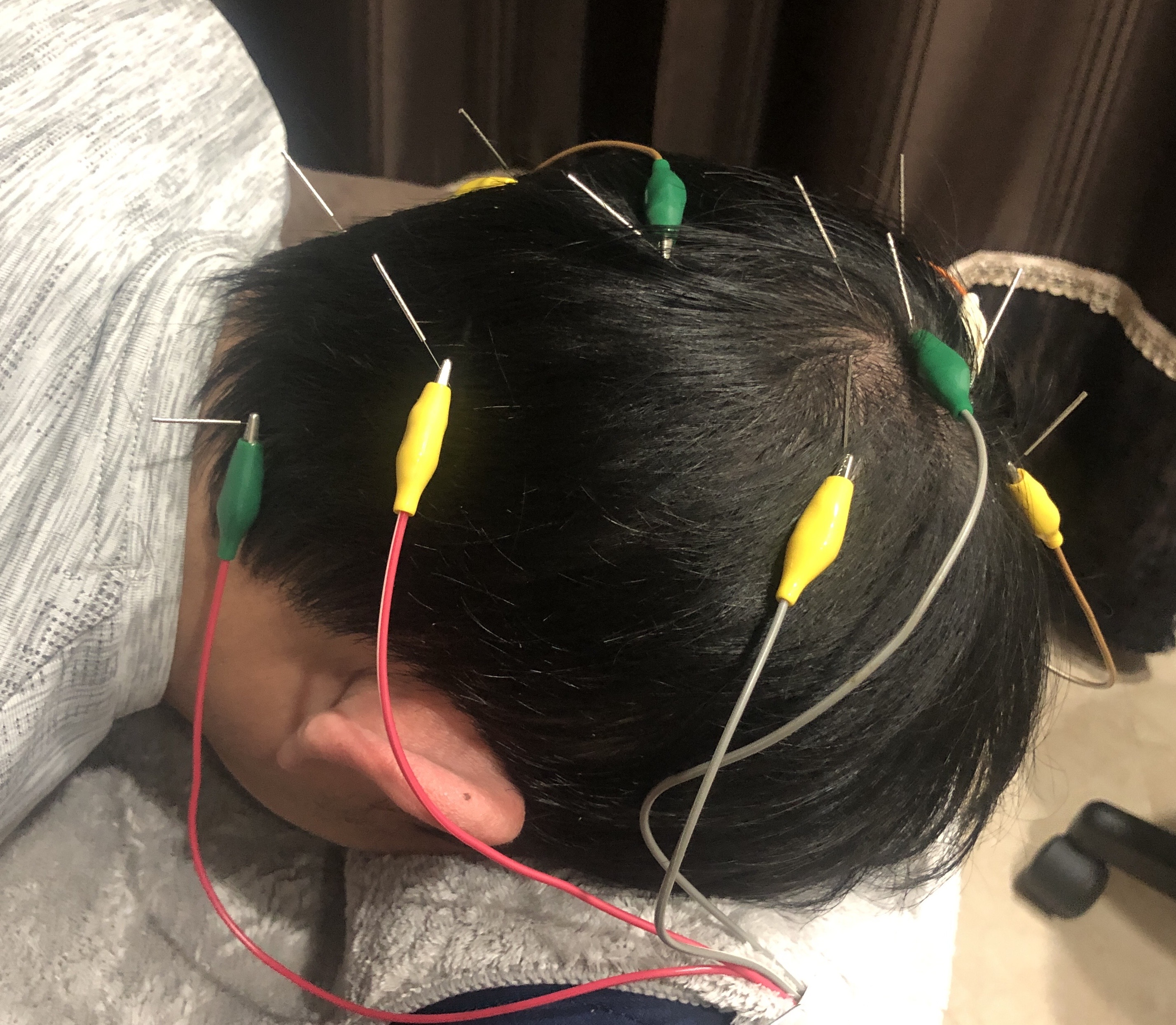 セントラル鍼灸院Re:laxy 育毛鍼/前回施術より14日までの方のメニュー画像