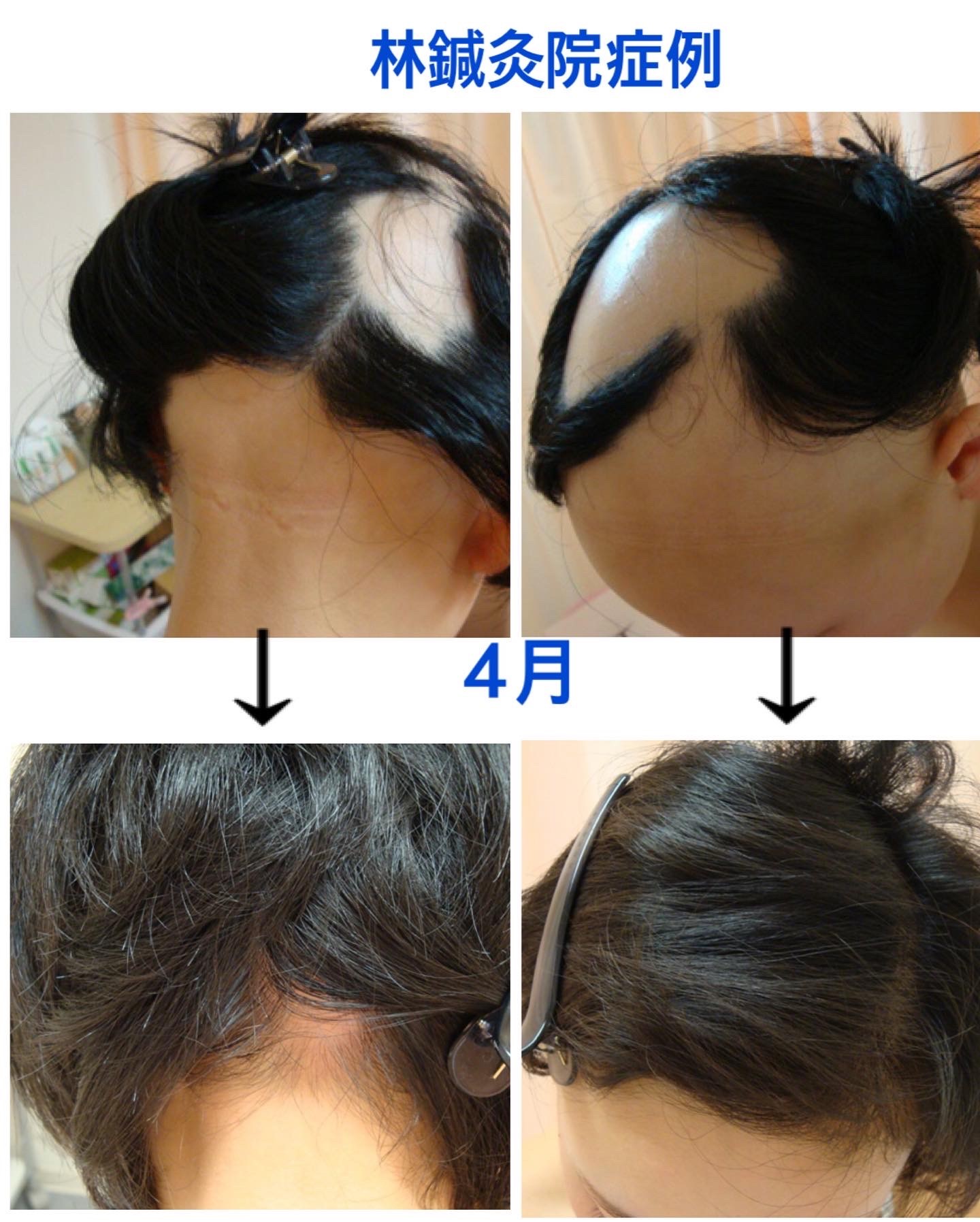 林鍼灸院 円形脱毛症の鍼治療のメニュー画像