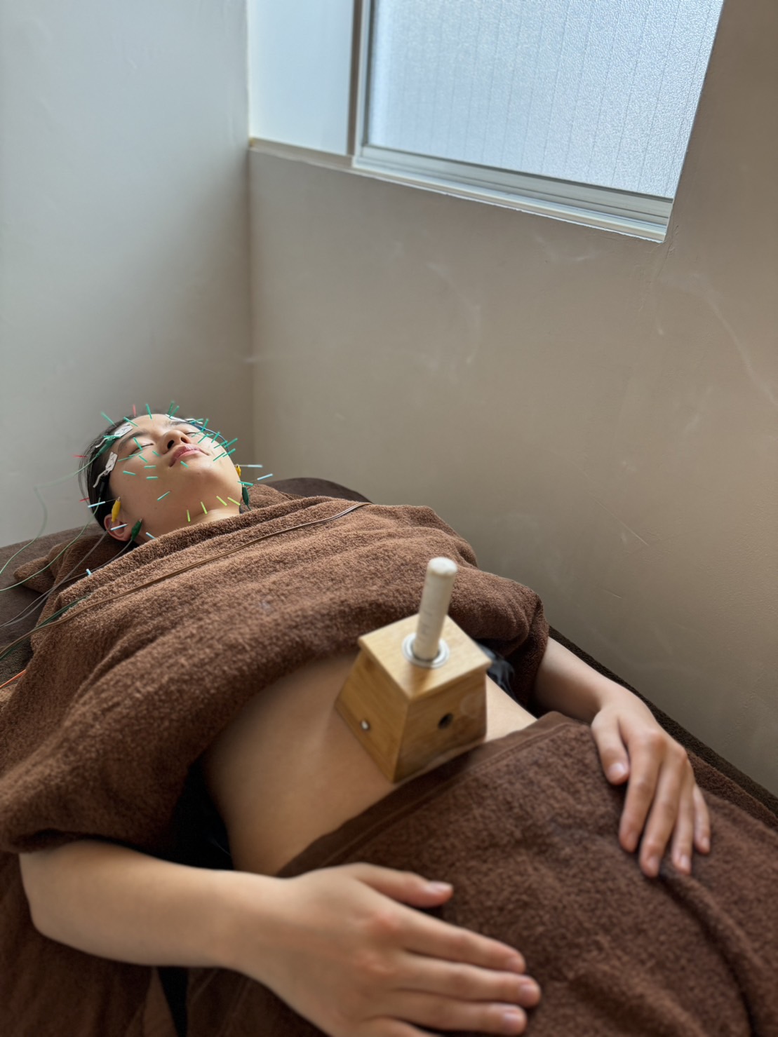 reCare道玄坂鍼灸院 トータル美容鍼灸コース（全身）のメニュー画像