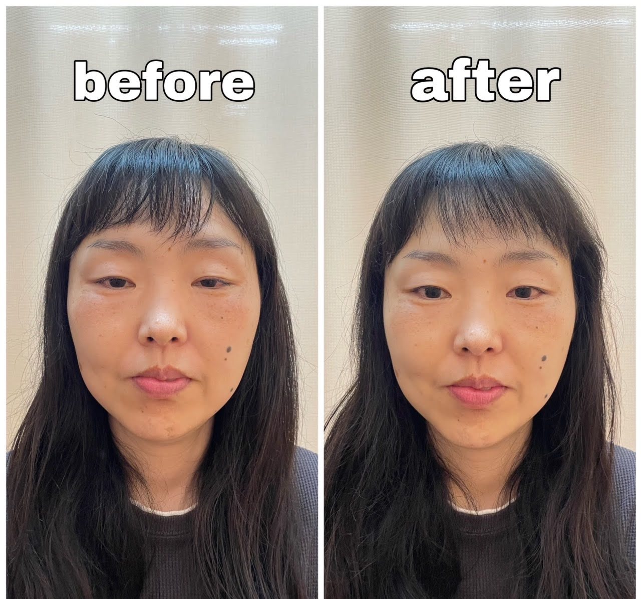 福山小顔美容鍼サロン 超小顔美容鍼コースのメニュー画像