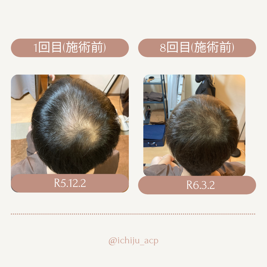 一樹鍼灸院 薄毛改善特化コースプレミアムのメニュー画像
