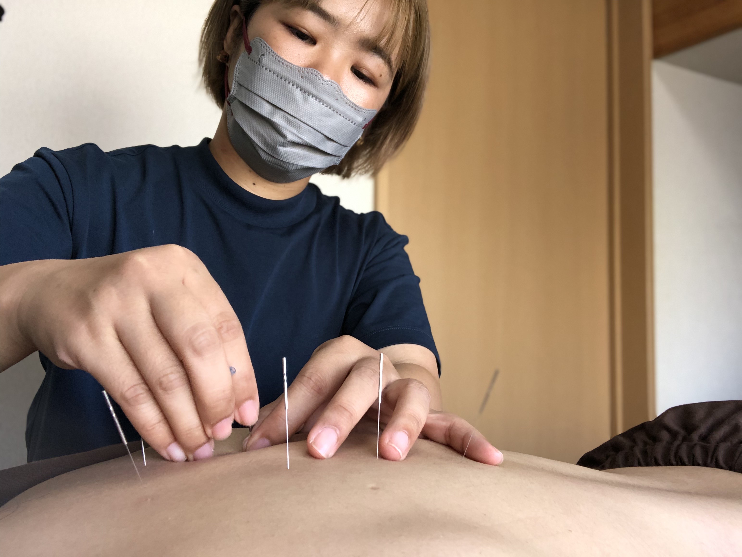 からふる鍼灸接骨院 はり施術　全身のメニュー画像