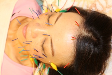 所沢鍼灸整体院 初回限定『リフトアップ美容鍼』コースのメニュー画像