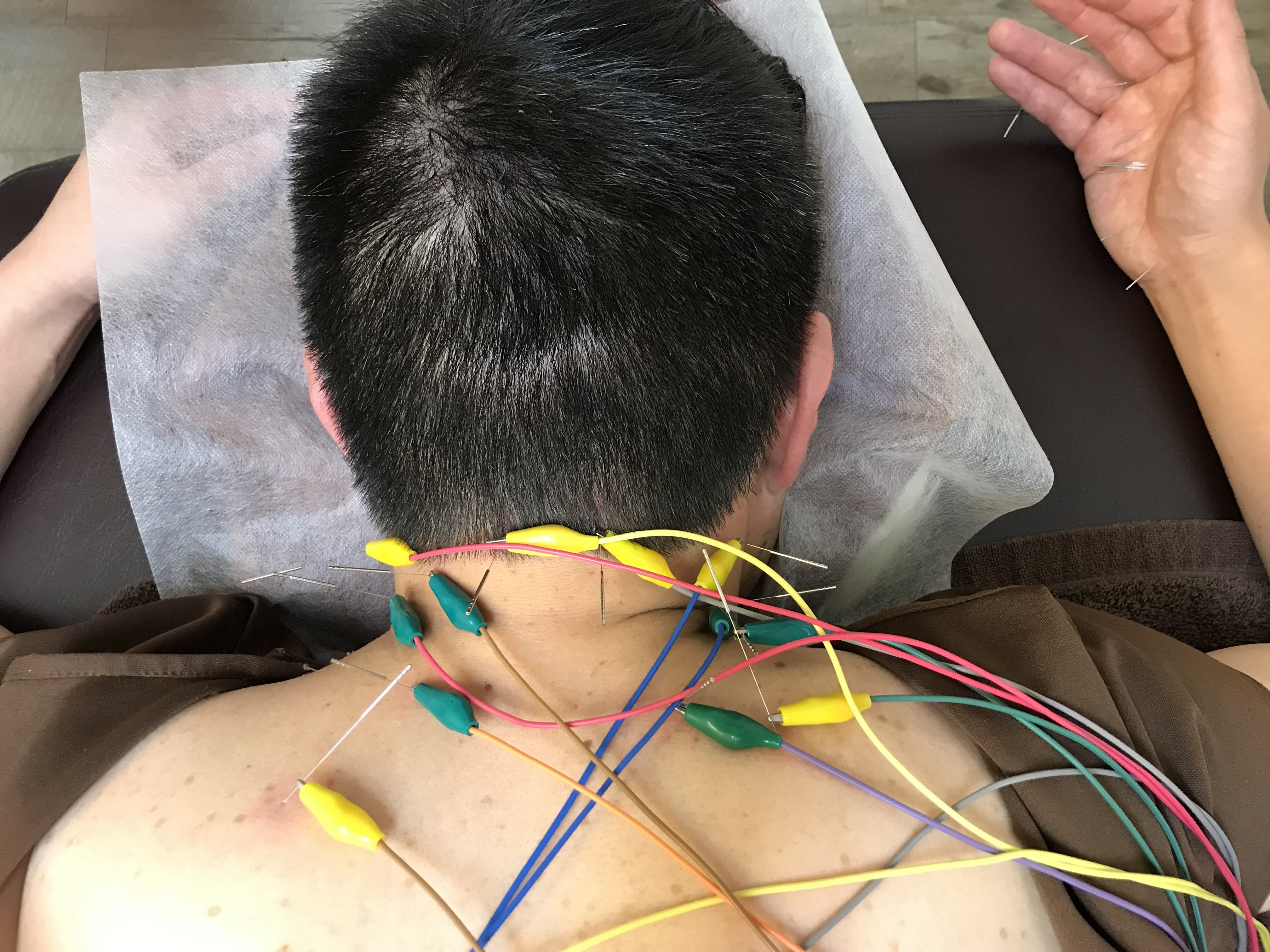 所沢鍼灸整体院 初回限定　肩こり腰痛鍼灸治療コースのメニュー画像