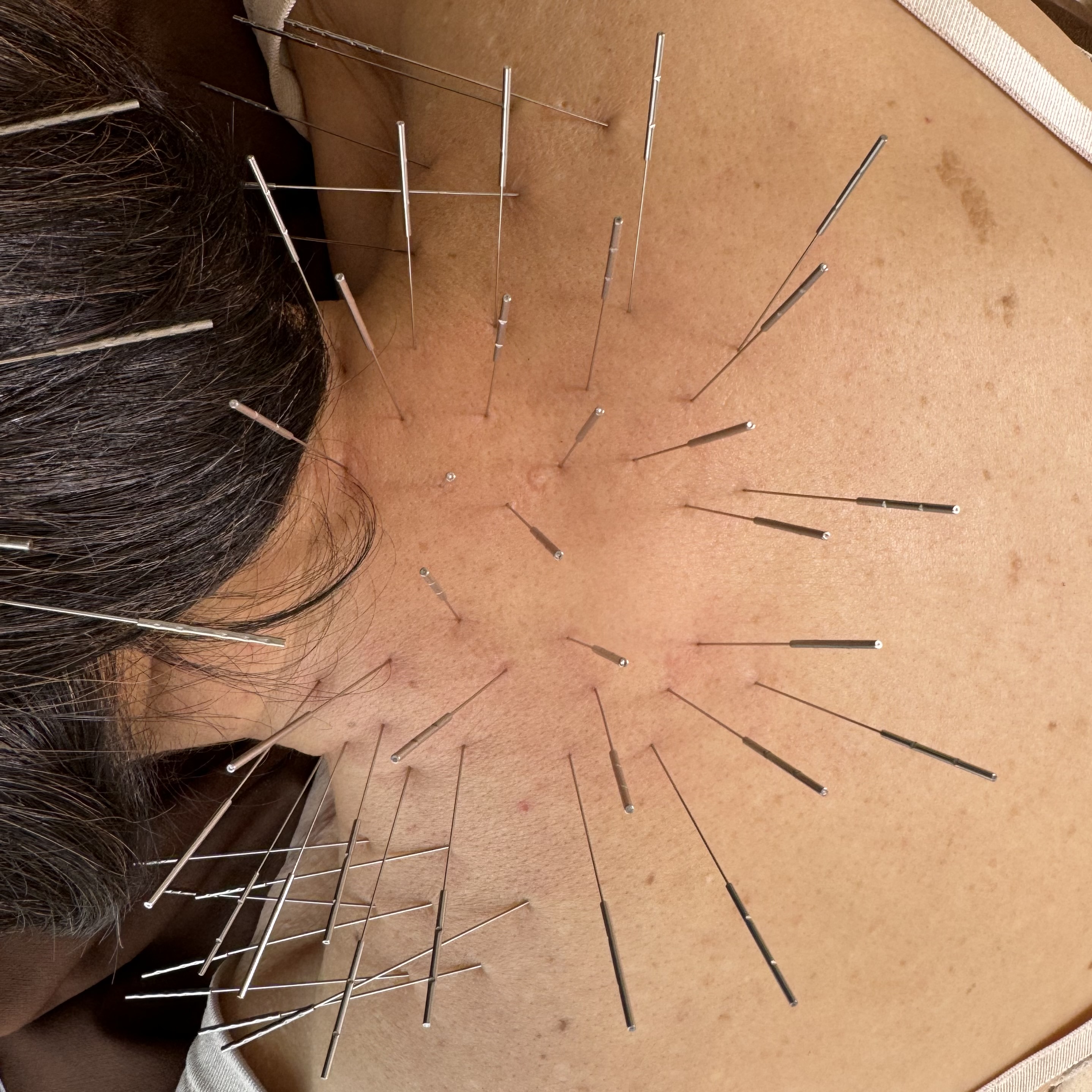 鍼灸整体　いろは -彩心-（ルート治療専門院） ルート鍼治療　30分のメニュー画像
