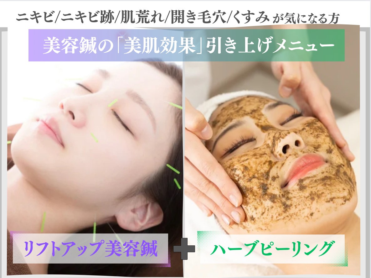 【メリハリ小顔・透明美肌】お顔の美容専門サロン-ハリステリア-≪H・S≫ 小顔リフトアップ美容鍼×ハーブピーリングのメニュー画像