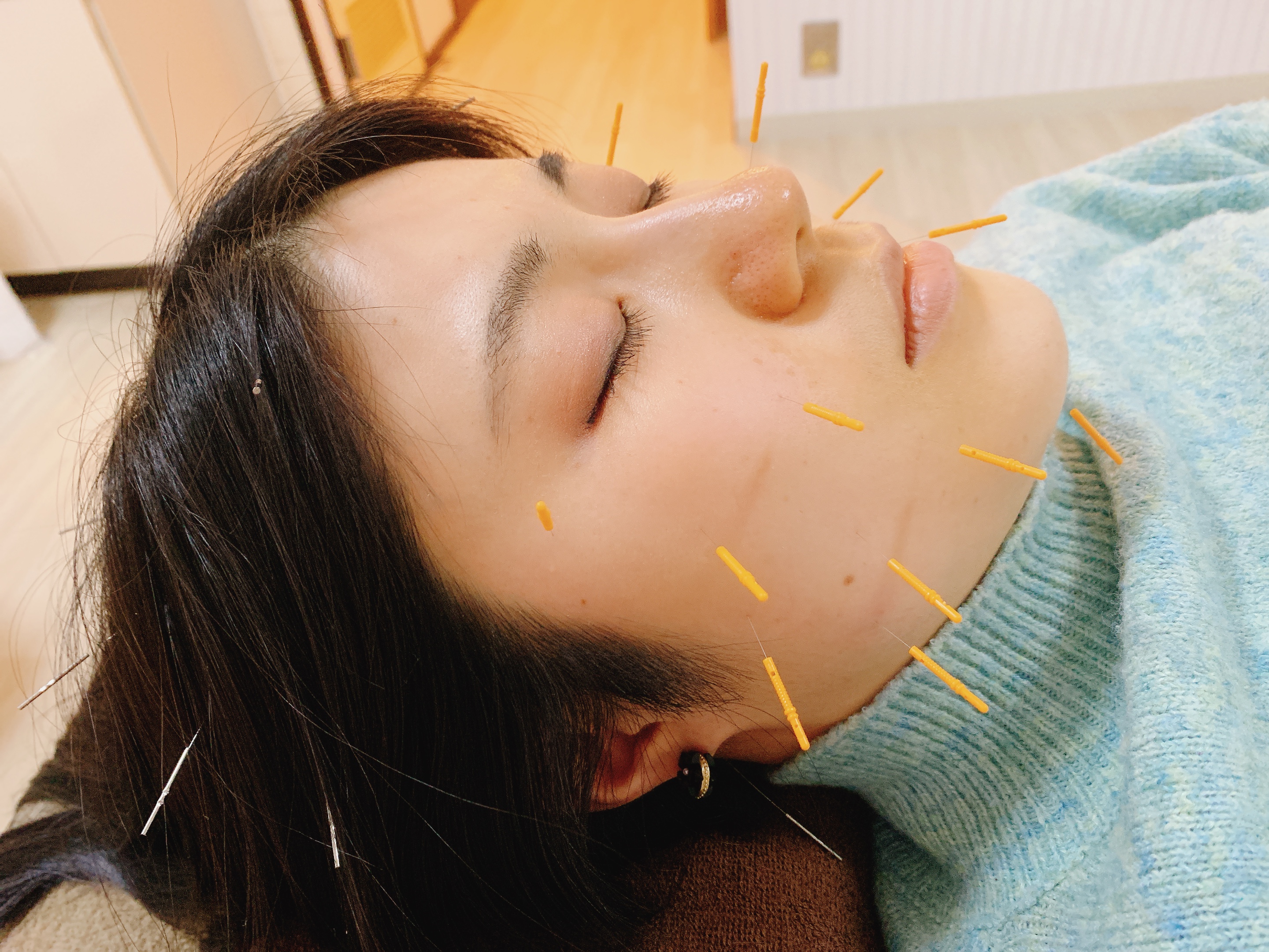 CHI-TOMA~はりきゅう~ 美容鍼お顔集中コースのメニュー画像