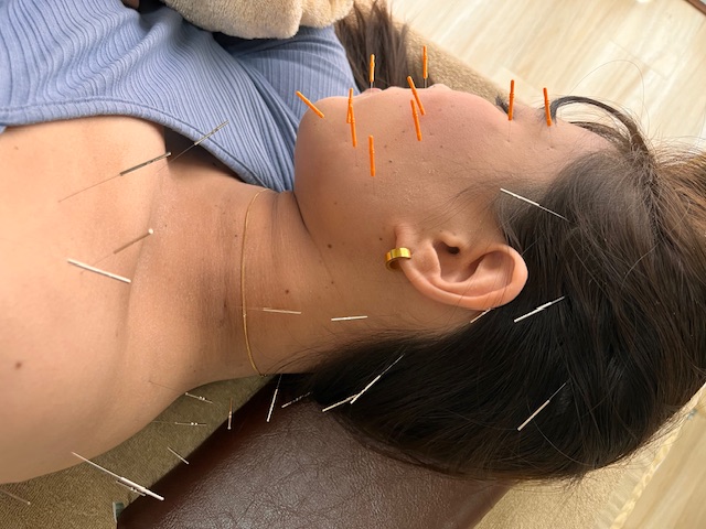 CHI-TOMA~はりきゅう~ 美容鍼灸全身コースのメニュー画像