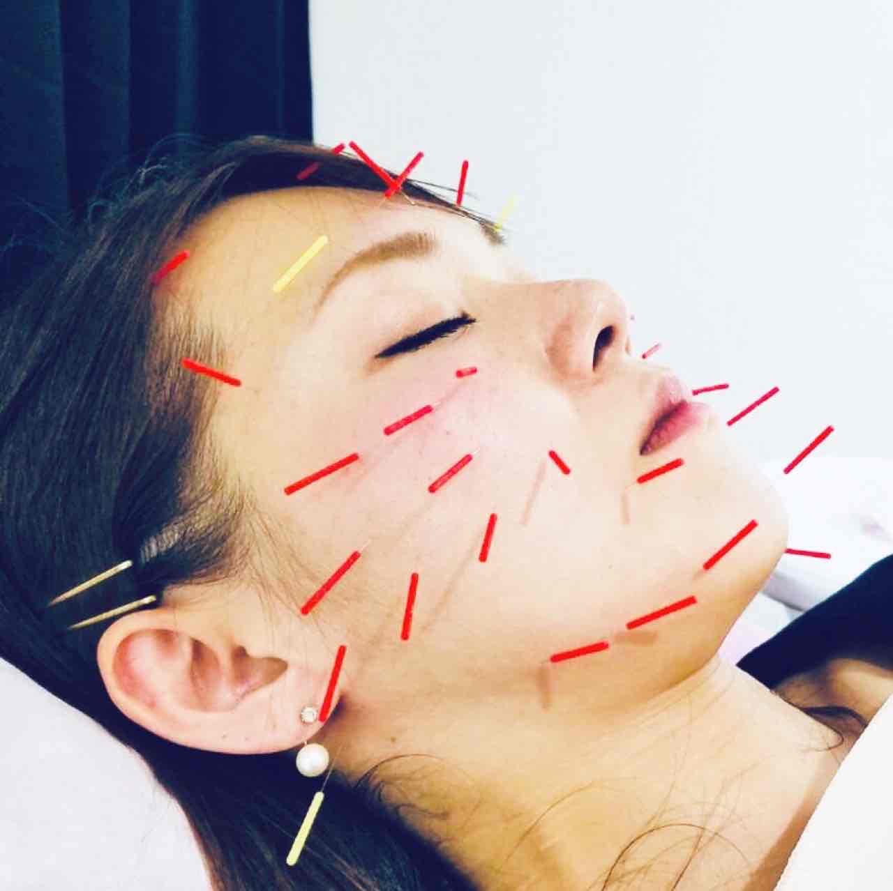 女性専門鍼灸サロン　はにかむ トータルケアコース🌟炭酸ケア付きのメニュー画像