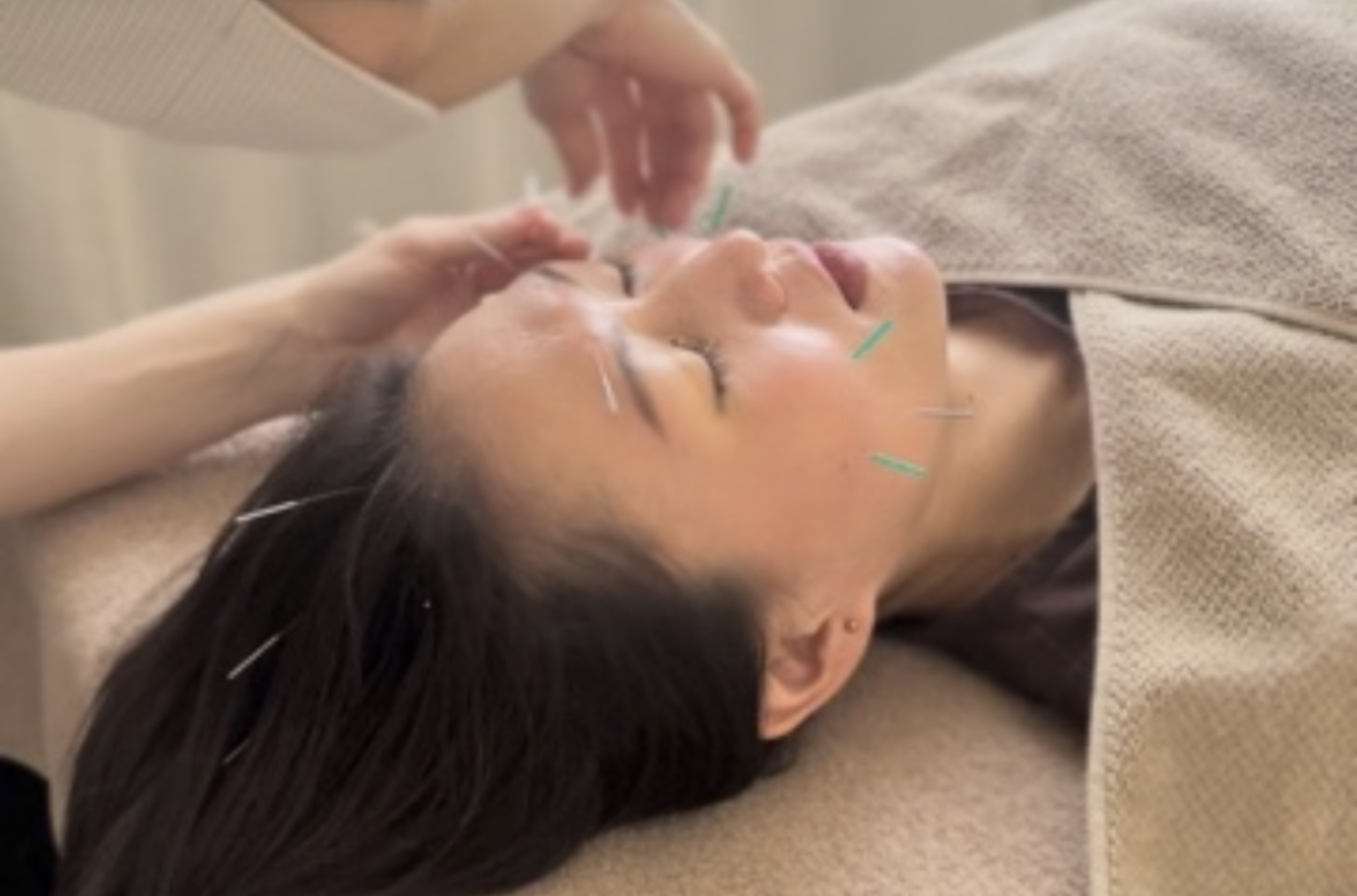 美容鍼こはりび こはりび美容鍼（４０分）【表情筋活性化】のメニュー画像