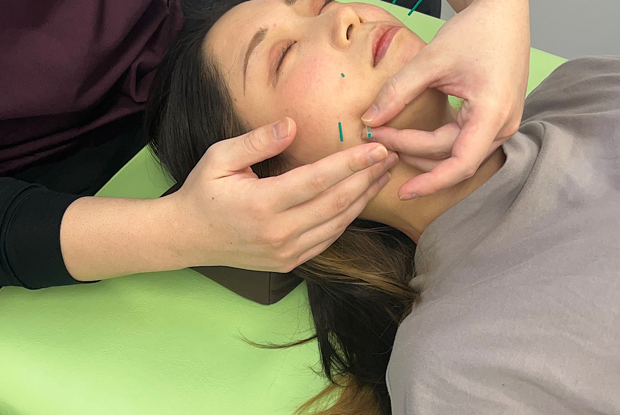 がじゅまるの木　小顔と不妊専門鍼灸 初回限定）フル美容鍼　Dariaのメニュー画像