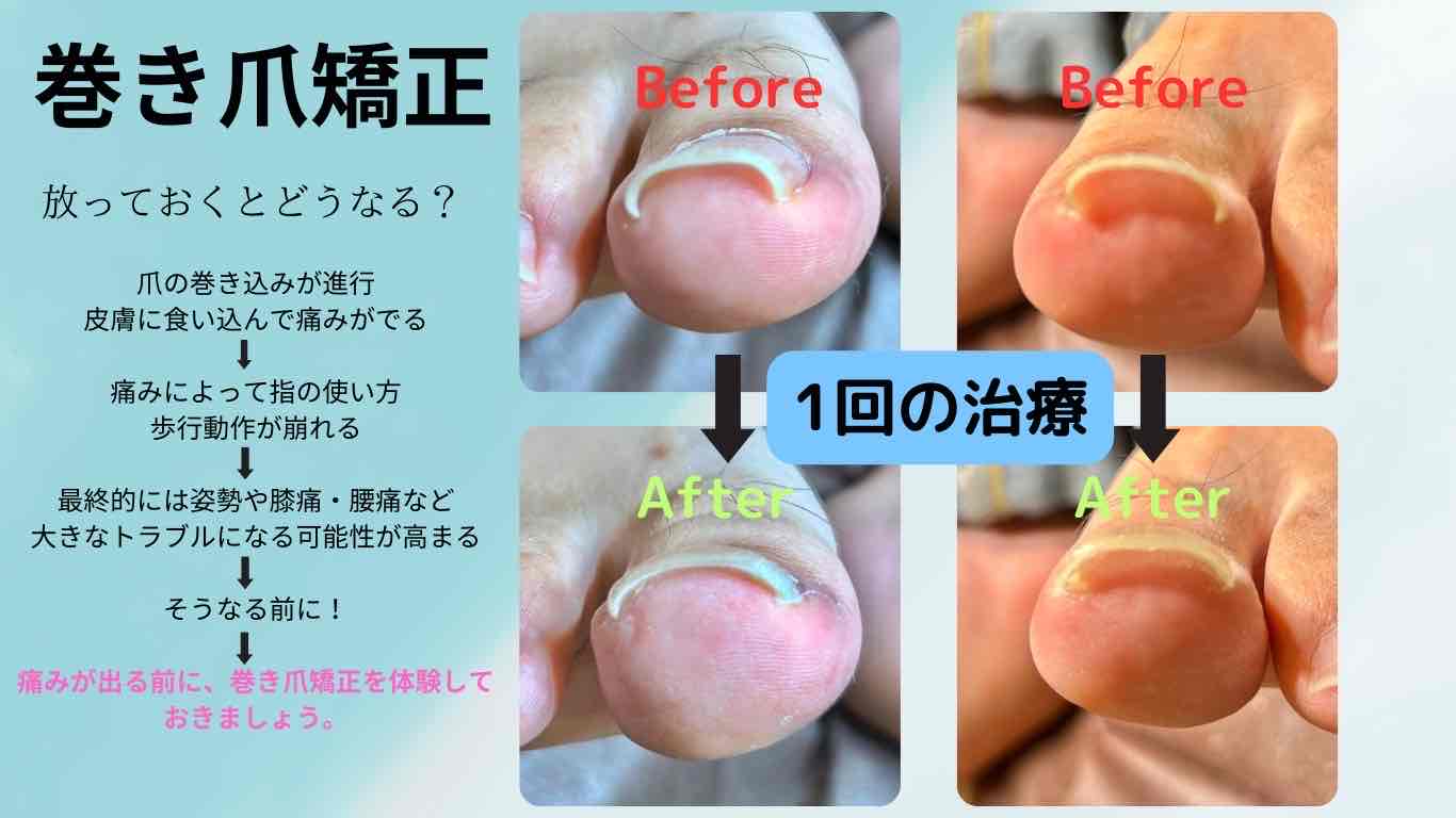 ふじもり桜花整骨院【鍼灸・美容鍼・加圧トレーニング・骨盤調整】 巻き爪治療のメニュー画像