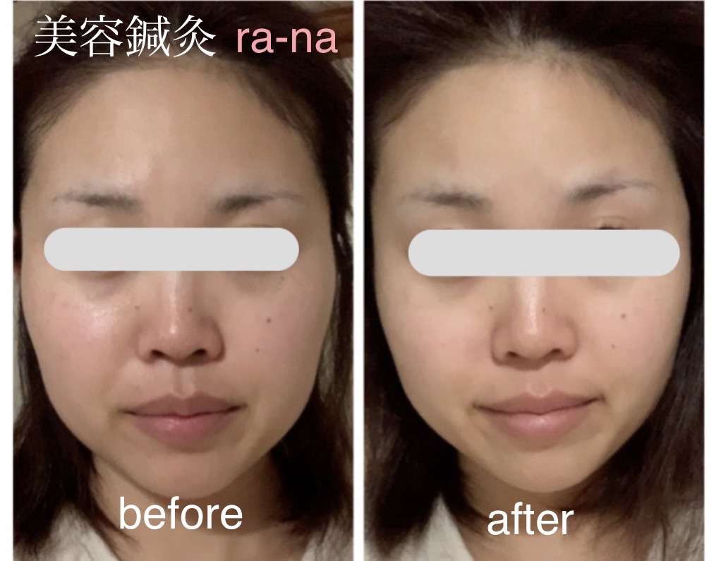 女性のための鍼灸サロン:ra-na 美容鍼灸のメニュー画像