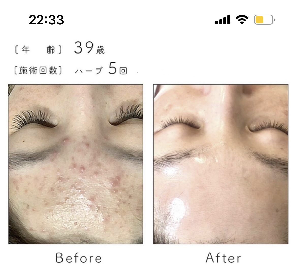 女性のための鍼灸サロン:ra-na リベルハーブピーリングのメニュー画像