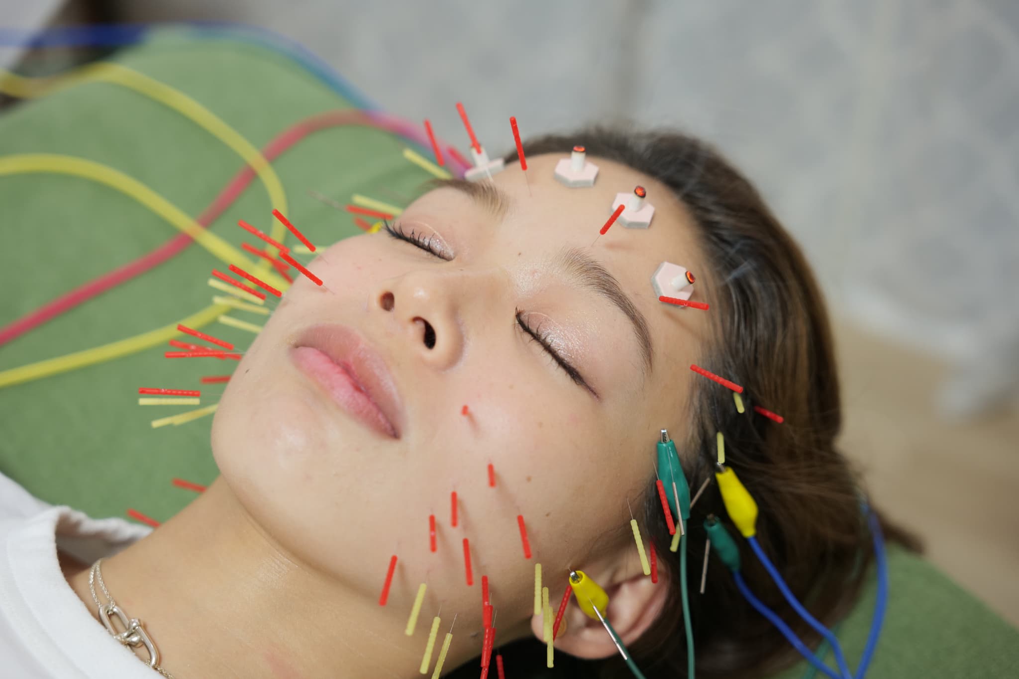 美顔鍼灸整体院凛と慶 1回目から効果実感の電気鍼のメニュー画像