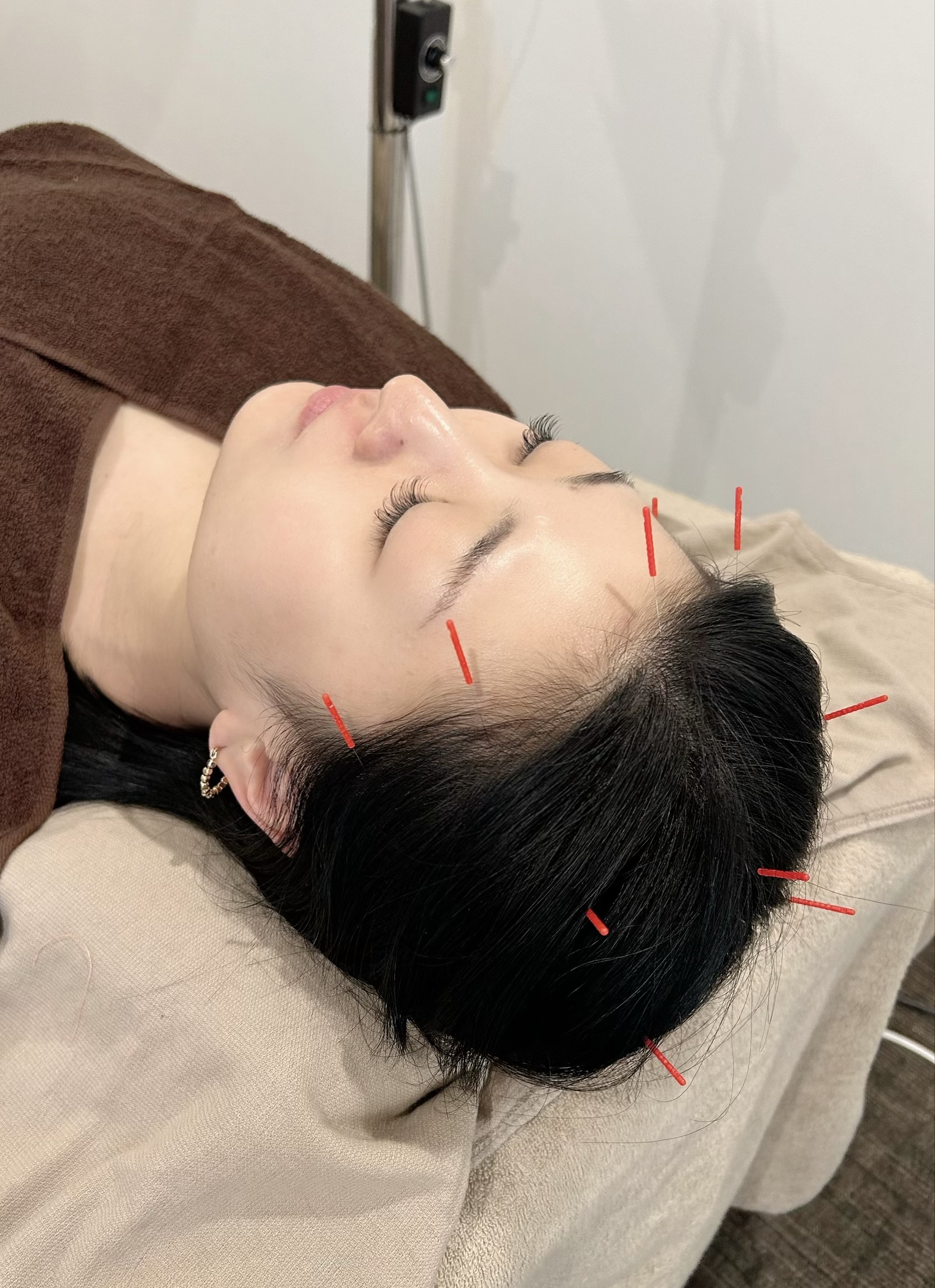 鍼灸サロン紅葉-MOMIJI- 頭皮鍼のメニュー画像