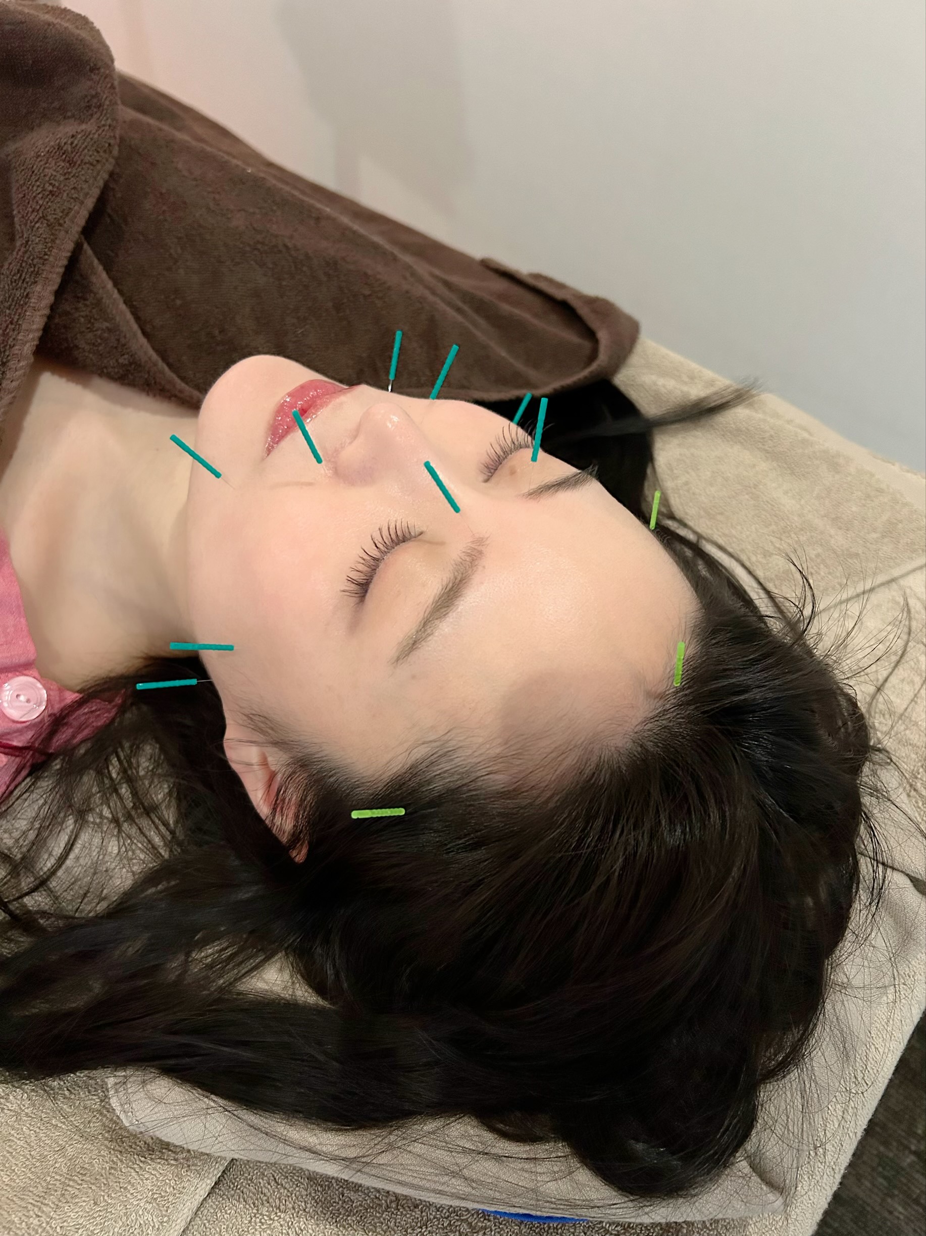 鍼灸サロン紅葉-MOMIJI- 美容鍼のメニュー画像