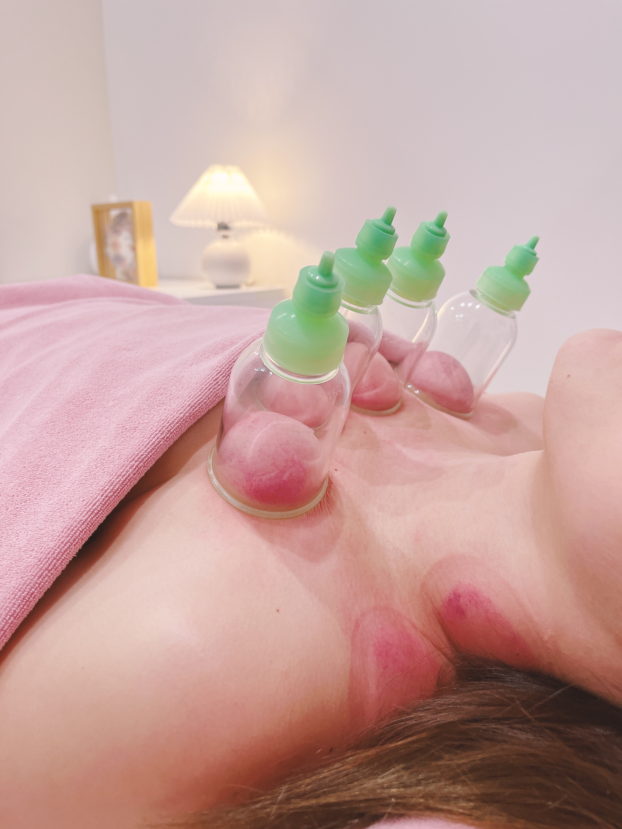 美容鍼灸サロン　Sachi-幸- デコルテカッピングor下半身カッピングのみのメニュー画像