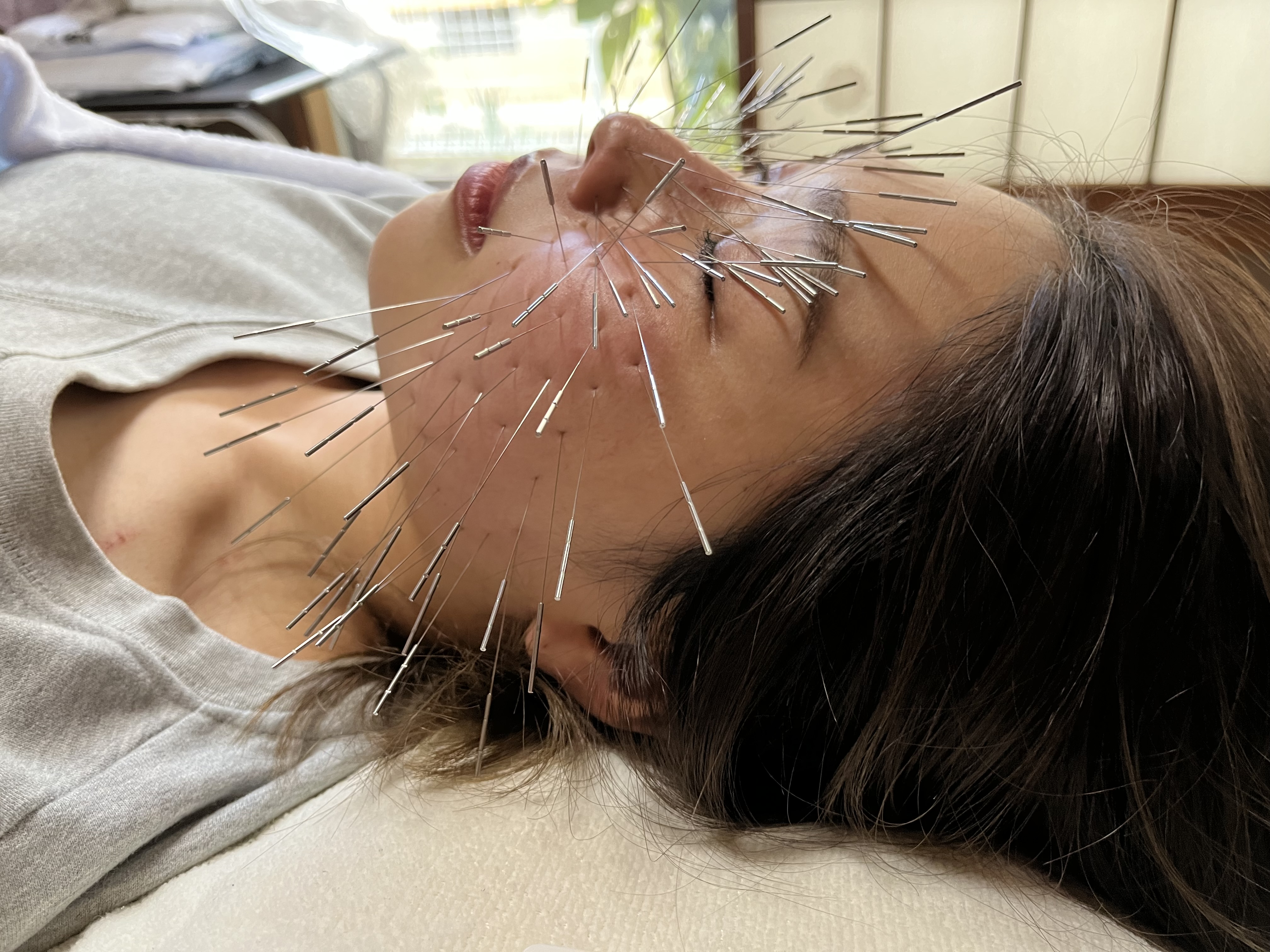 鍼処HIKARIE（旧光鍼灸院） ルート治療美容鍼【15分】のメニュー画像