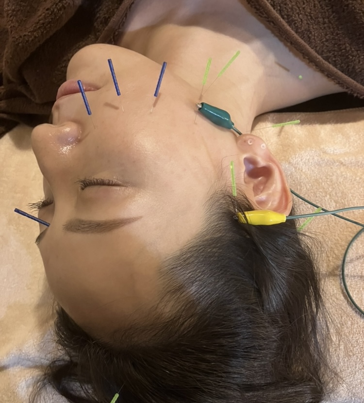 NADI SHINQ 女性限定　お試しコース〈美容鍼〉60分7,000円のメニュー画像