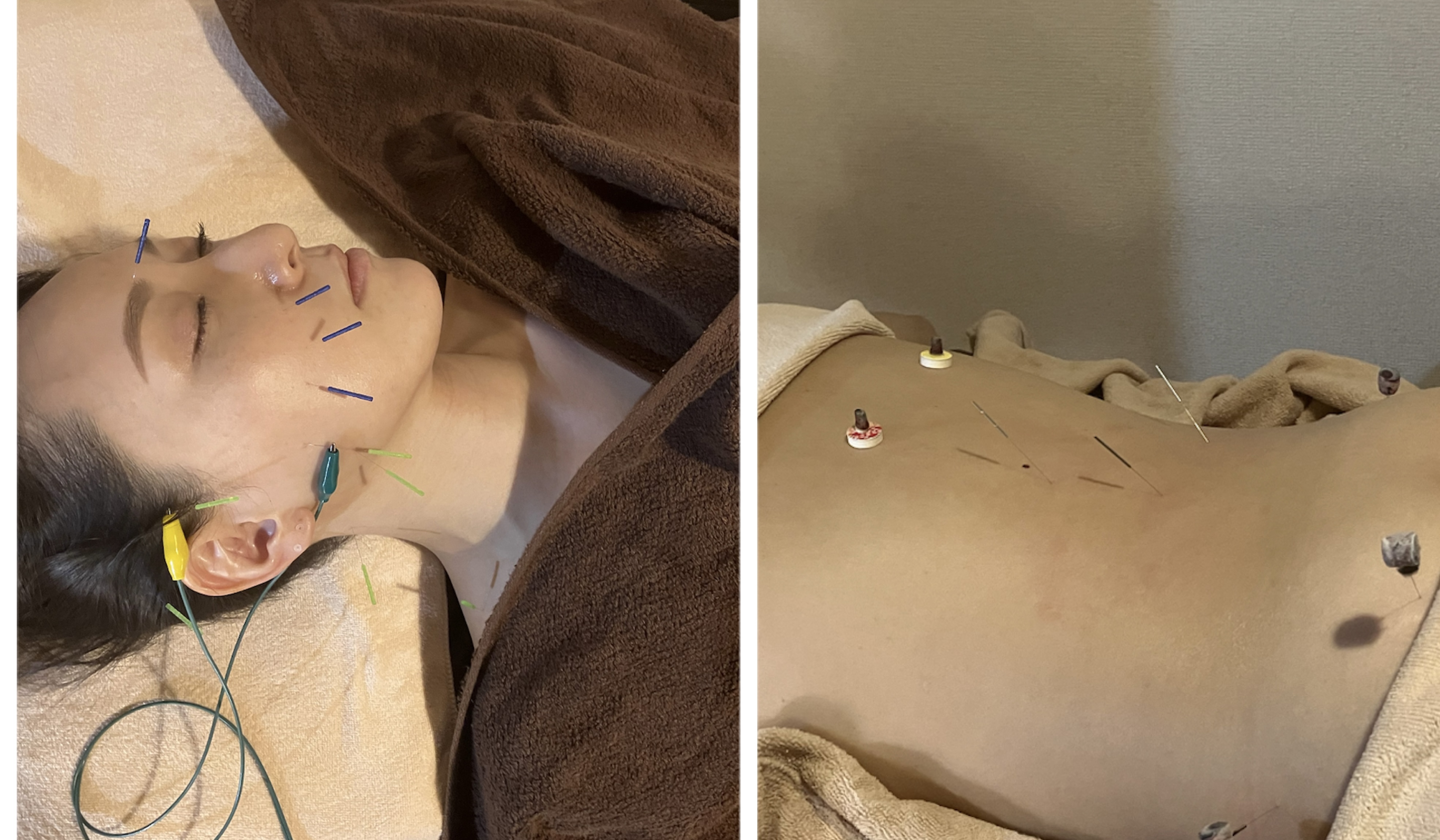 NADI SHINQ 女性限定　お試しコース〈美容鍼＋体ケア〉のメニュー画像