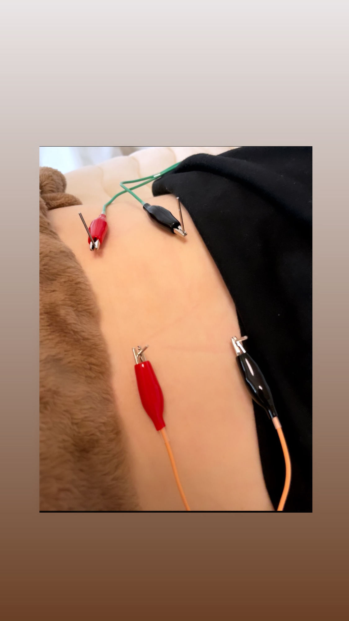 Lindo 鍼灸治療（電気を流す鍼）のメニュー画像