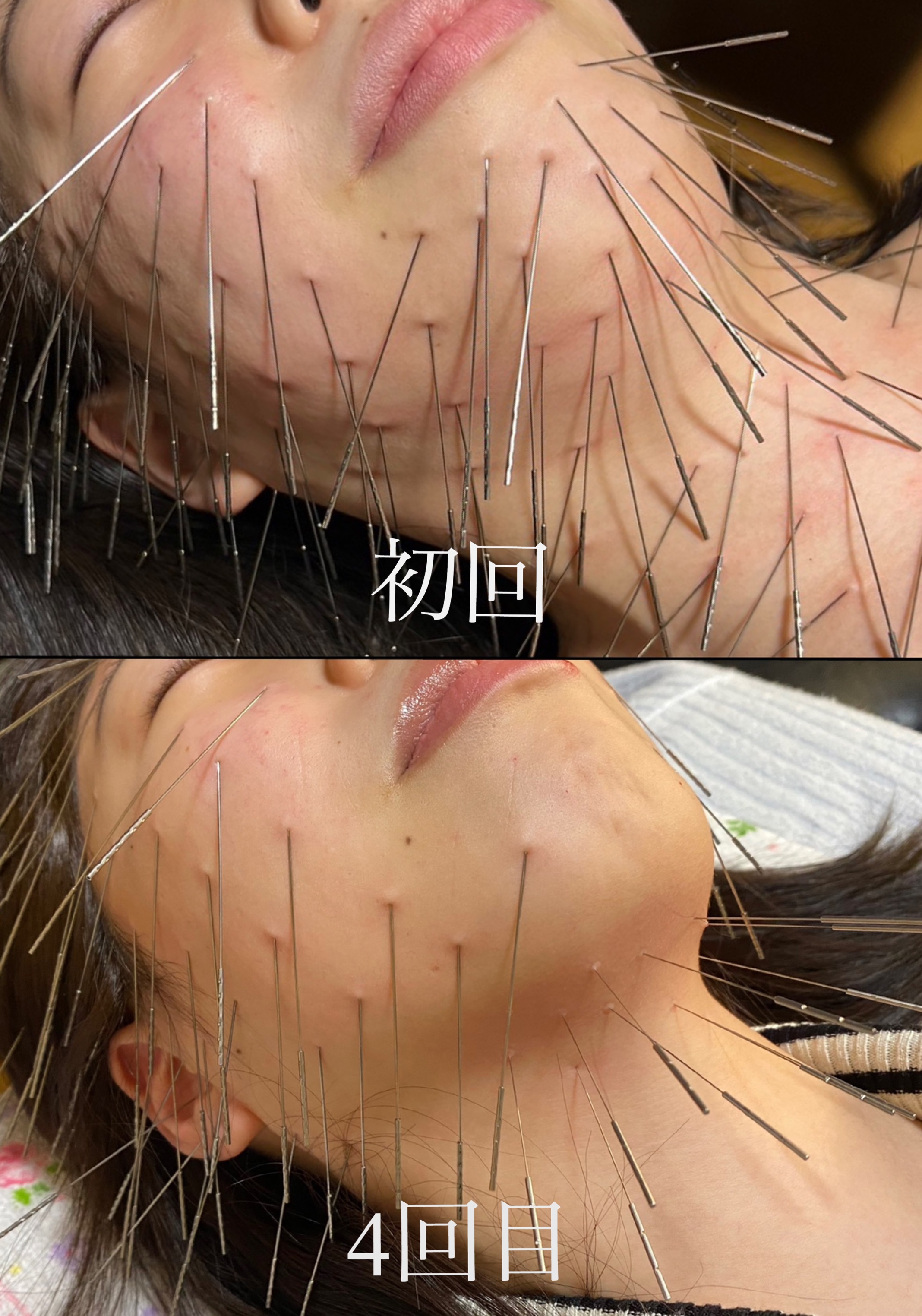 鍼処 ｕ.【ルート治療専門】 【鬼美容鍼】圧倒的持続力！眼精疲労や花粉症、脳疲労の改善にも◎のメニュー画像