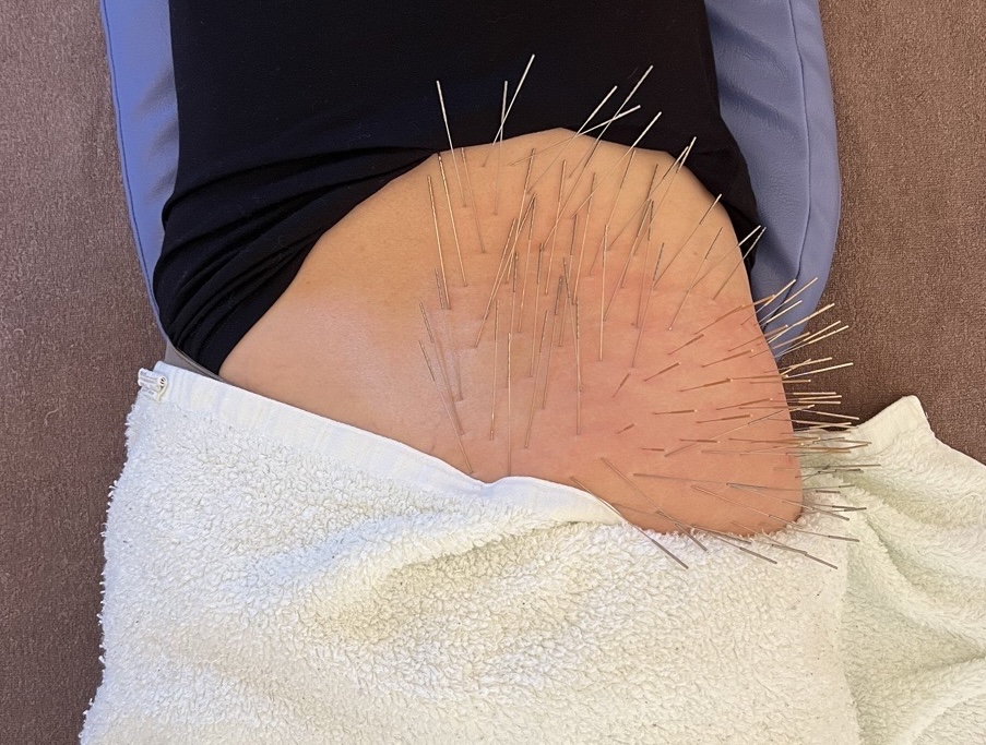 美容鍼とルート治療による鬼美容鍼　まちばり鍼灸院 ルート治療による鬼美容鍼に追加する身体へのルート治療のメニュー画像